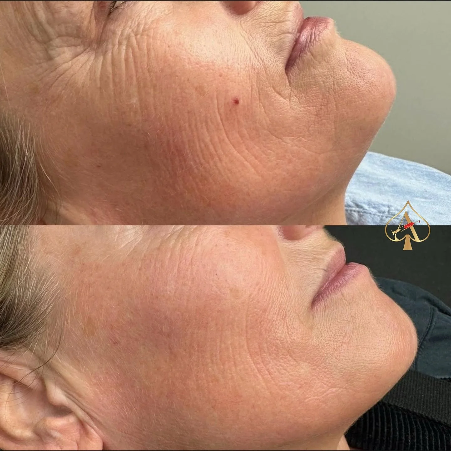 Meet Skinvive &mdash; the glow treatment everyone&rsquo;s talking about. 😻

Unlike traditional filler, this isn&rsquo;t about adding volume &mdash; it&rsquo;s about deeply hydrating your skin from the inside out. Think of it as a micro-infusion of h