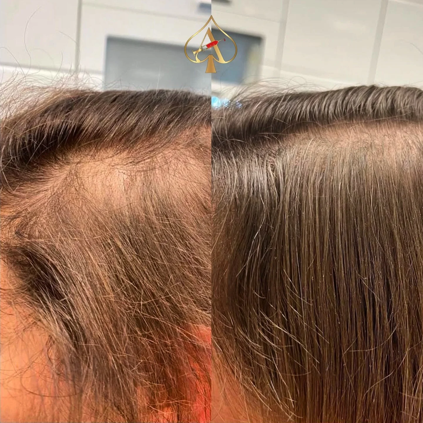 Get healthy, revitalized hair this season with PRF! 🌿✨ Unlike PRP, Platelet-Rich Fibrin (PRF) is packed with more growth factors and natural healing properties, making it a more effective and long-lasting solution for hair rejuvenation. 💁🏽&zwj;♀️ 