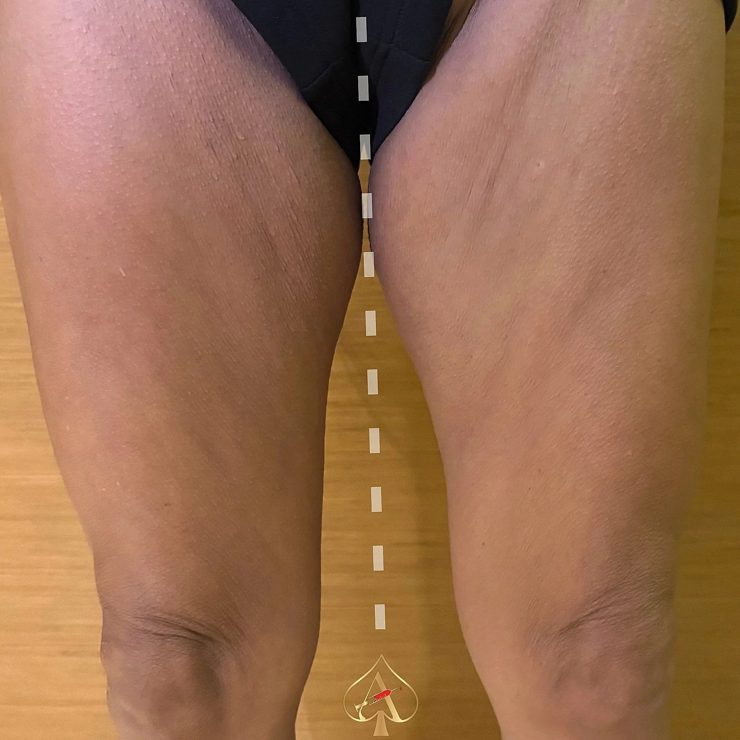 Introducing our brand new RF skin-tightening technology! 🌍 Straight from the world&rsquo;s leading aesthetics conference in Dubai, where innovation meets results.

🔥 Why RF?
	&bull;	Lifts and tightens loose skin
	&bull;	Stimulates natural collagen 