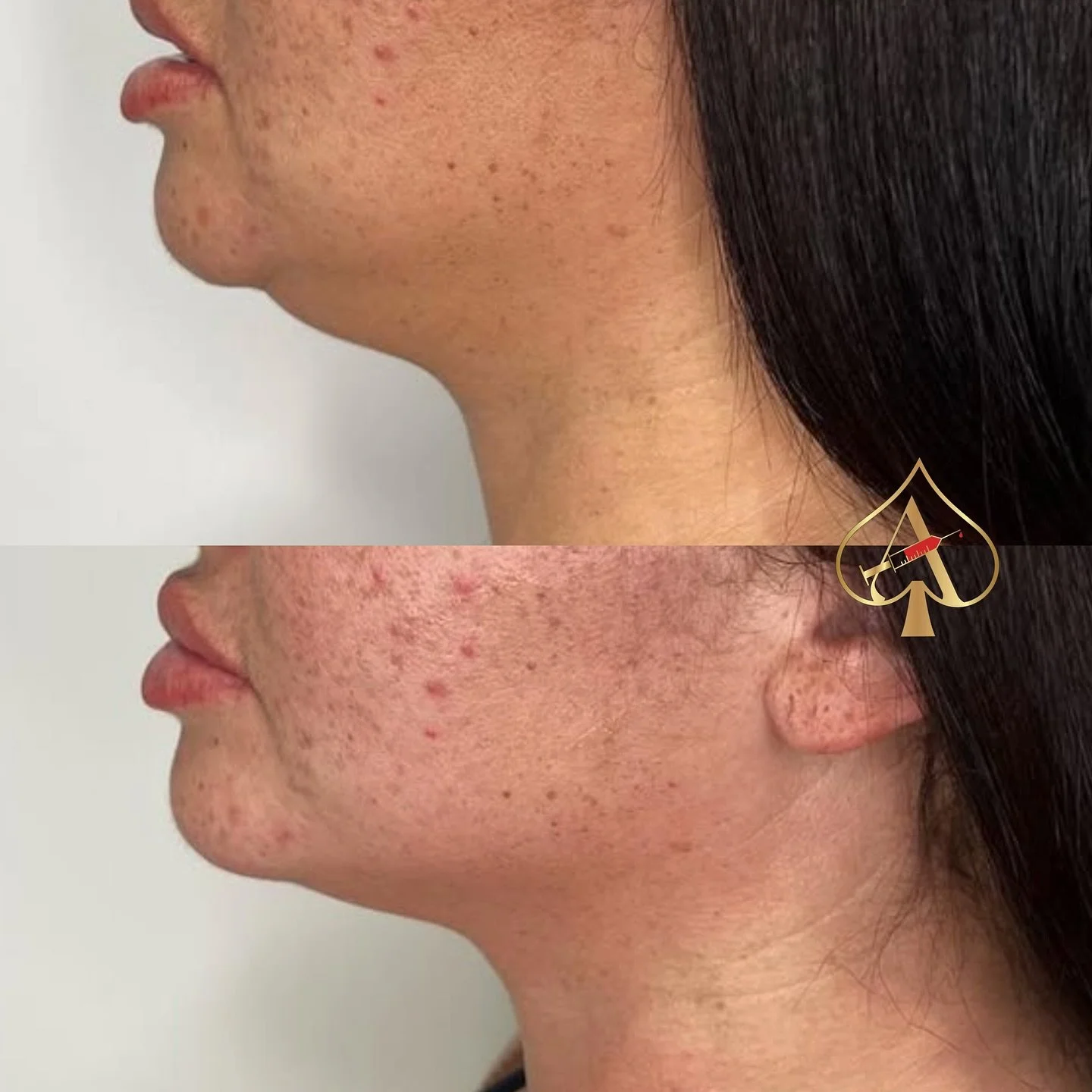 Noticing a “double chin” in some of the photos you’ve been taking recently? What if we told you there was a to eliminate that submental fat PERMANENTLY? π« 
PCDC (Phosphatidylcholine and Deoxycholate) fat dissolving injections are