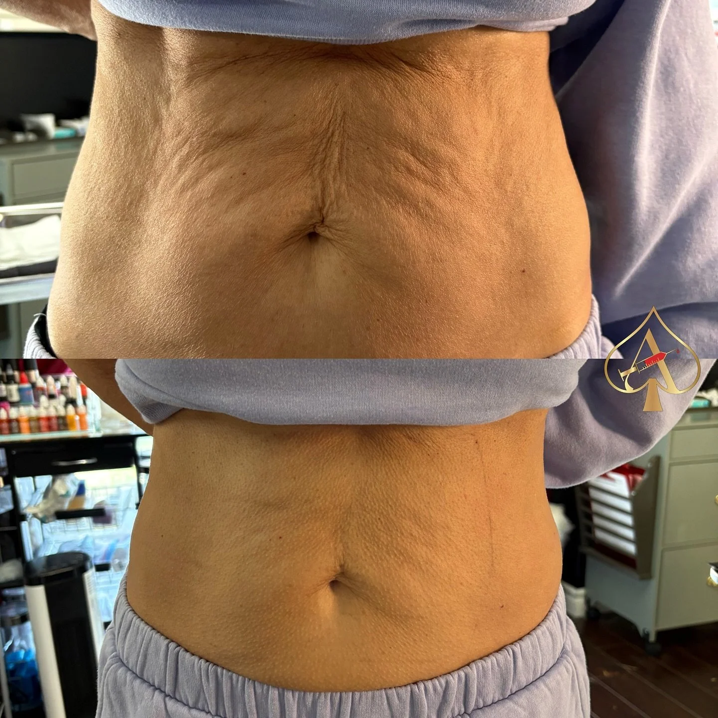 Real people. Real results. Really in just 15 minutes. 
π₯ Why RF?
	•	Lifts and tightens loose skin
	•	Stimulates natural collagen and elastin
	•	Smooths fine lines and wrinkles
	•	Firms jawline and contours the face
	•	Safe,