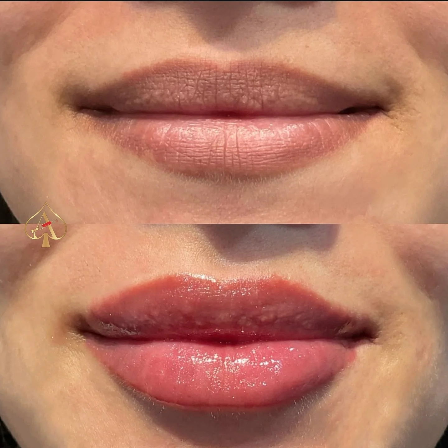 Fall glow-up season is here — and your lips deserve a little love, too. π 
A touch of filler can refresh your look, restore balance, and bring back that soft, effortless confidence. Because sometimes the best pick-me-up isn’t just a pum