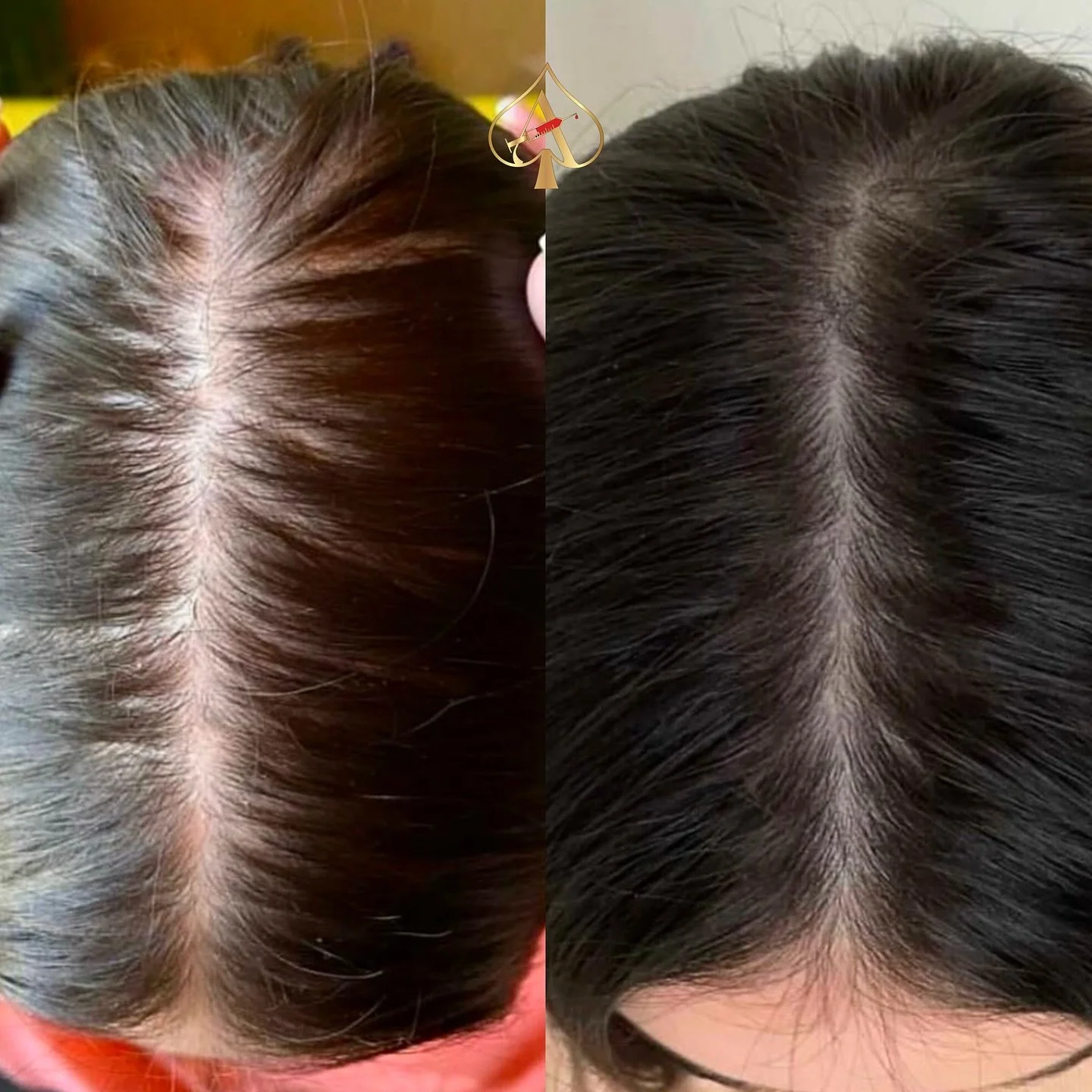 Thinning along your hairline or part? Let’s change that — naturally. π± 
Our PRF Hair Restoration treatment uses your body’s own growth factors to wake up dormant follicles, strengthen existing strands, and restore density where it