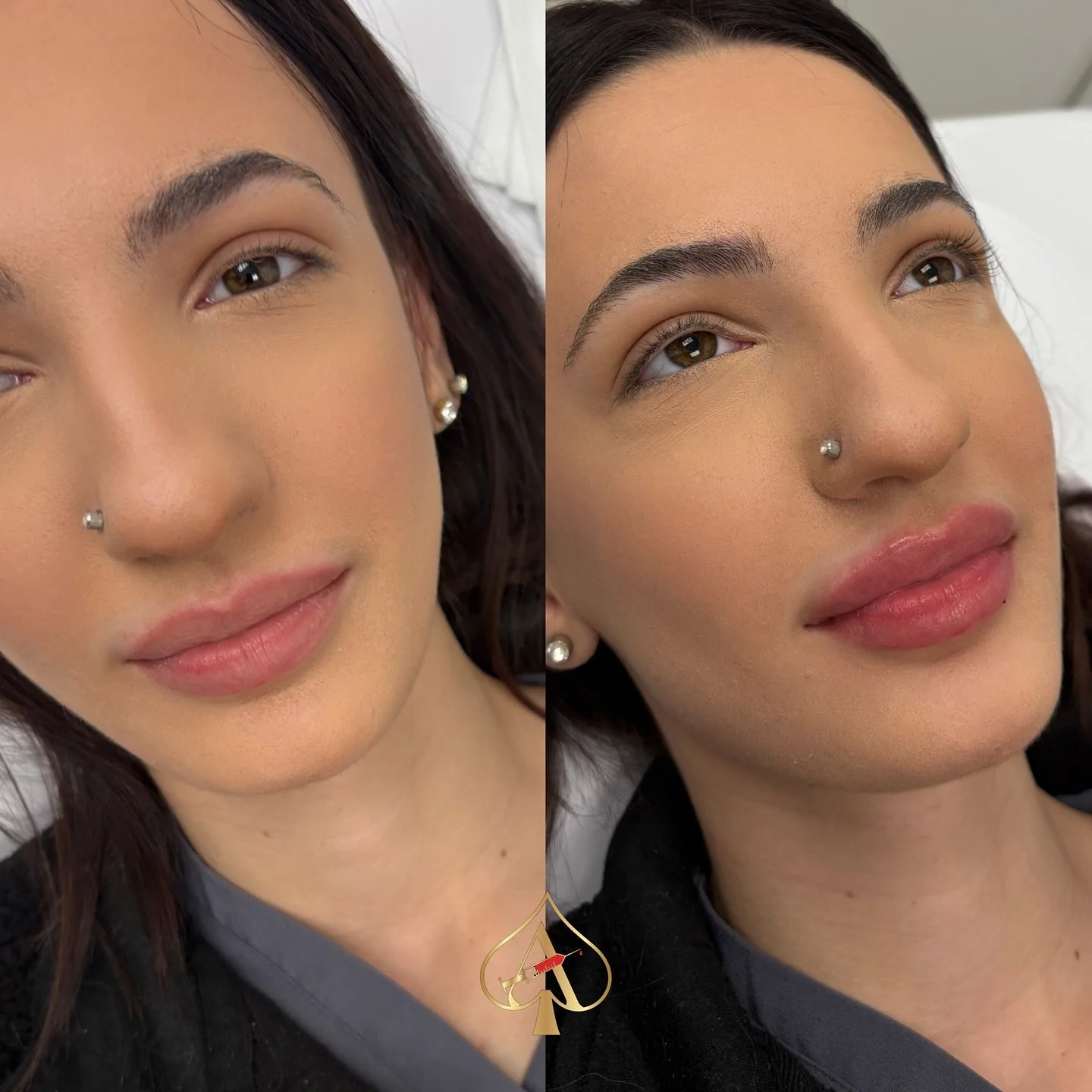 This beauty’s first time getting lip filler — just ½ syringe for that naturally enhanced, soft plush look. π
Sometimes it’s not about going bigger — it’s about going balanced.
A touch of volume can:
β¨ Define yo