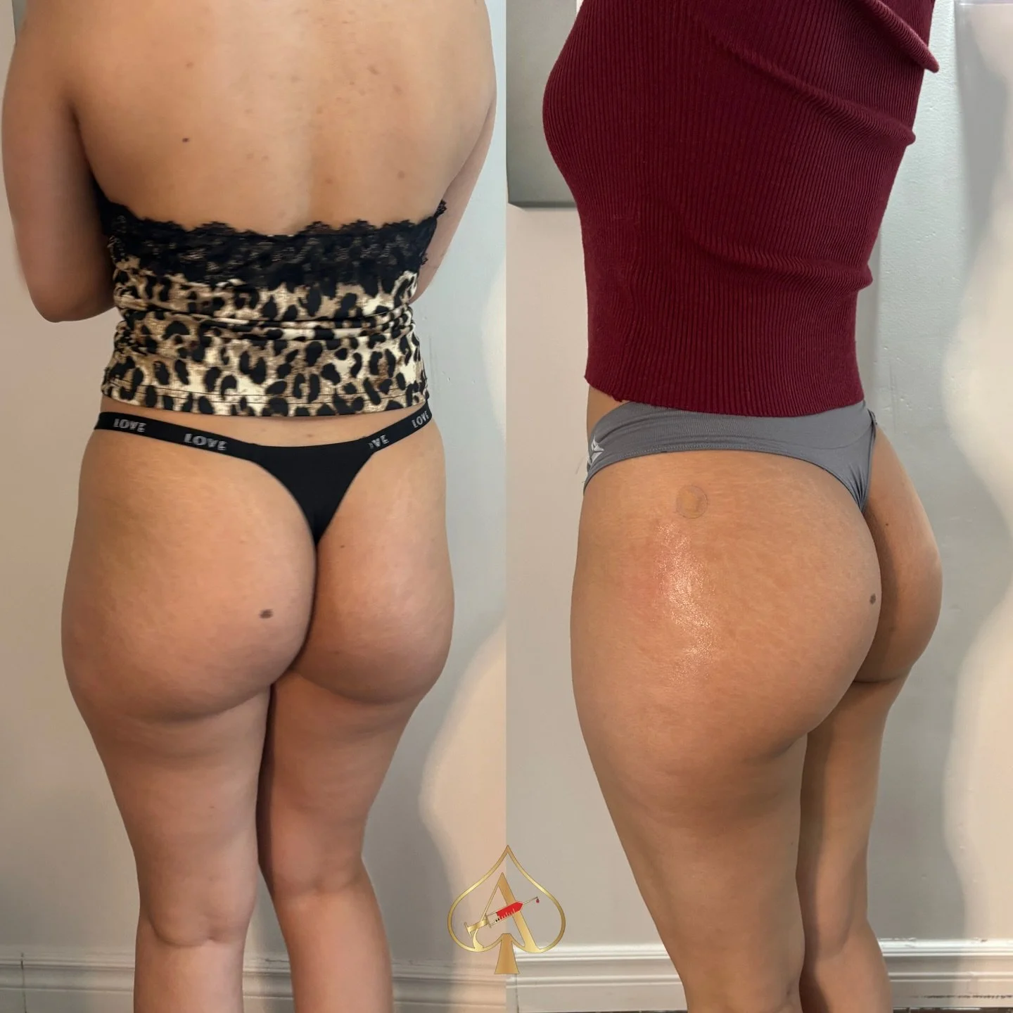 Sculpted. Defined. Plumped. β¨
Our non-surgical DreamCurve™ BBL enhances your natural shape using advanced filler techniques to smooth, lift, and contour your lower body — no downtime, no anesthesia, no drastic recovery.
βοΈ Immediate, na