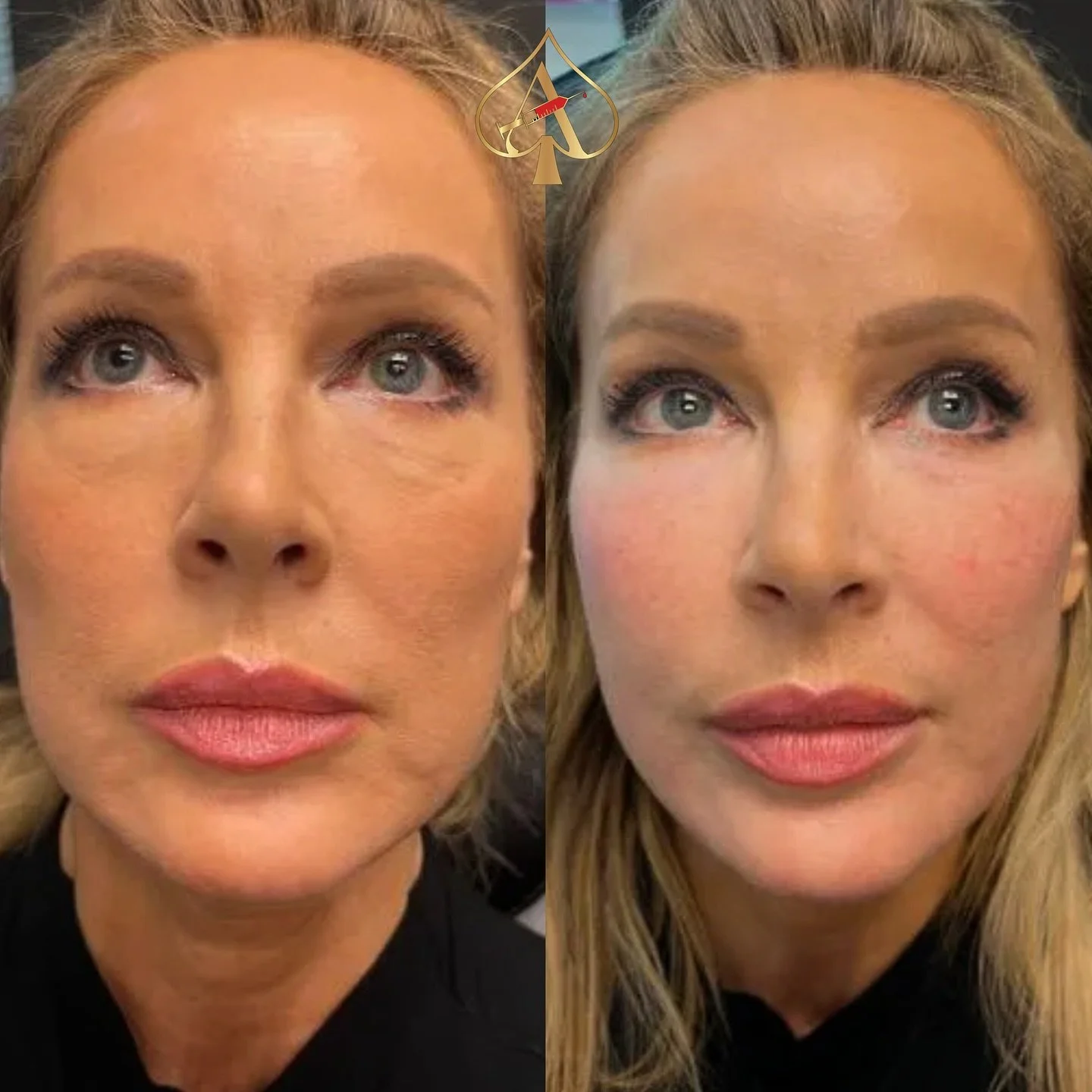 ORGANIC filler 🌱 Facial contouring in ONE session! 

✨ Get Holiday-Ready with PRP/PRF Bio Gel! ✨

Say goodbye to fine lines and hello to a more youthful, radiant you with our new Bio-Gel treatment! This organic filler composition harnesses the power