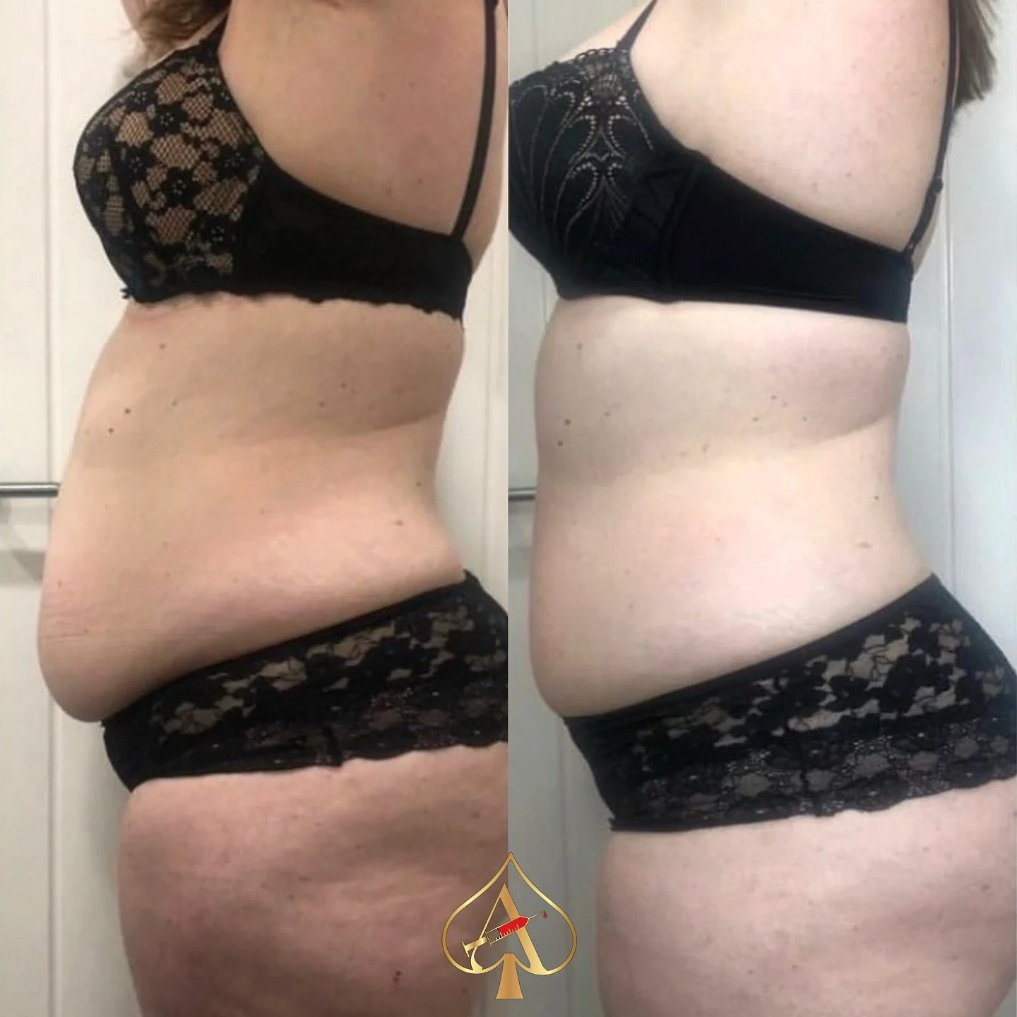 Stubborn &ldquo;mommy pooch&rdquo; just not giving in &mdash; no matter how clean you eat or how consistent you&rsquo;ve been?

It&rsquo;s not you &mdash; it&rsquo;s biology. And that&rsquo;s exactly where PCDC fat dissolving comes in.

💧 This gentl