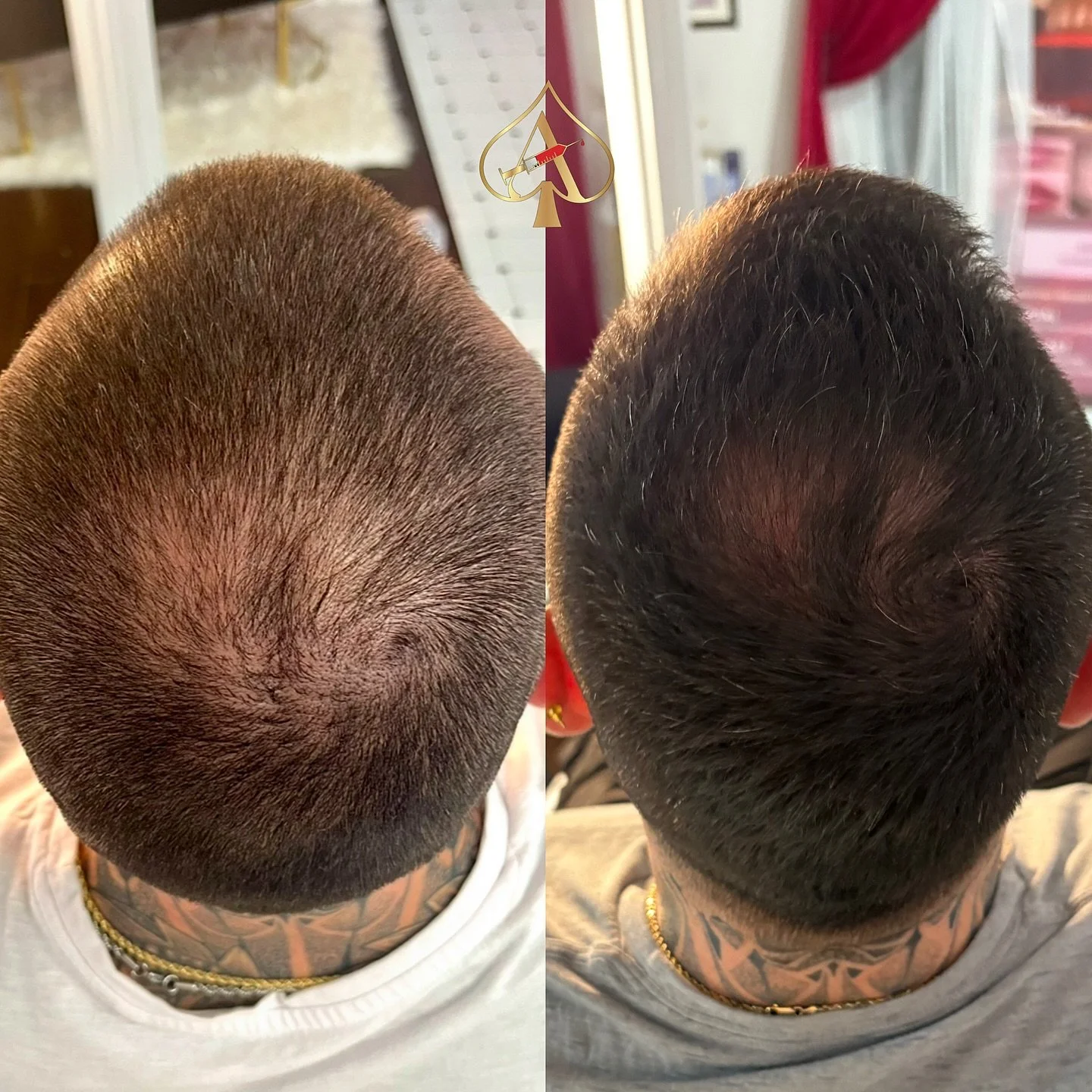 Thinning hair? Let&rsquo;s talk options that actually work &mdash; and don&rsquo;t involve surgery or fake promises.

PRF uses your own plasma to stimulate real, natural hair growth from the inside out.
These results? Only two treatments in.

Stronge