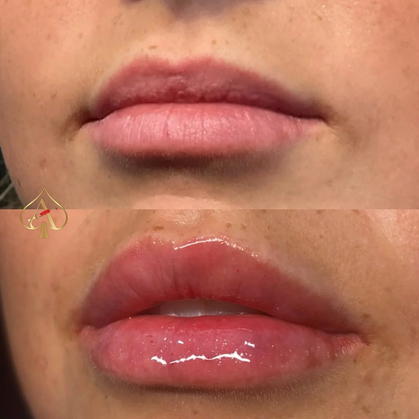 Patience = perfection. 💋 

This stunning transformation took two sessions &mdash; proof that the best results come from strategic, gradual building. We focused on shape, balance, and harmony, not just volume.

💋 Slow and steady always wins when it 
