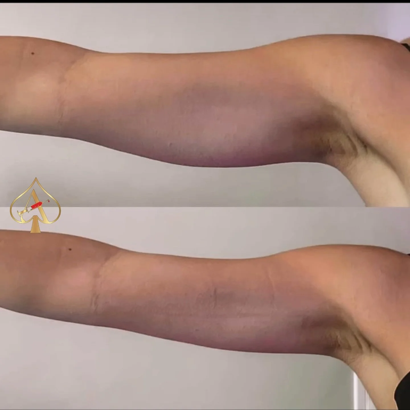 Unhappy with your arms? We can help with that 😉.

Our PCDC fat dissolving treatment targets stubborn arm fat that just won&rsquo;t budge, no matter how clean you eat or how many workouts you power through.

💉 This is permanent fat cell destruction 