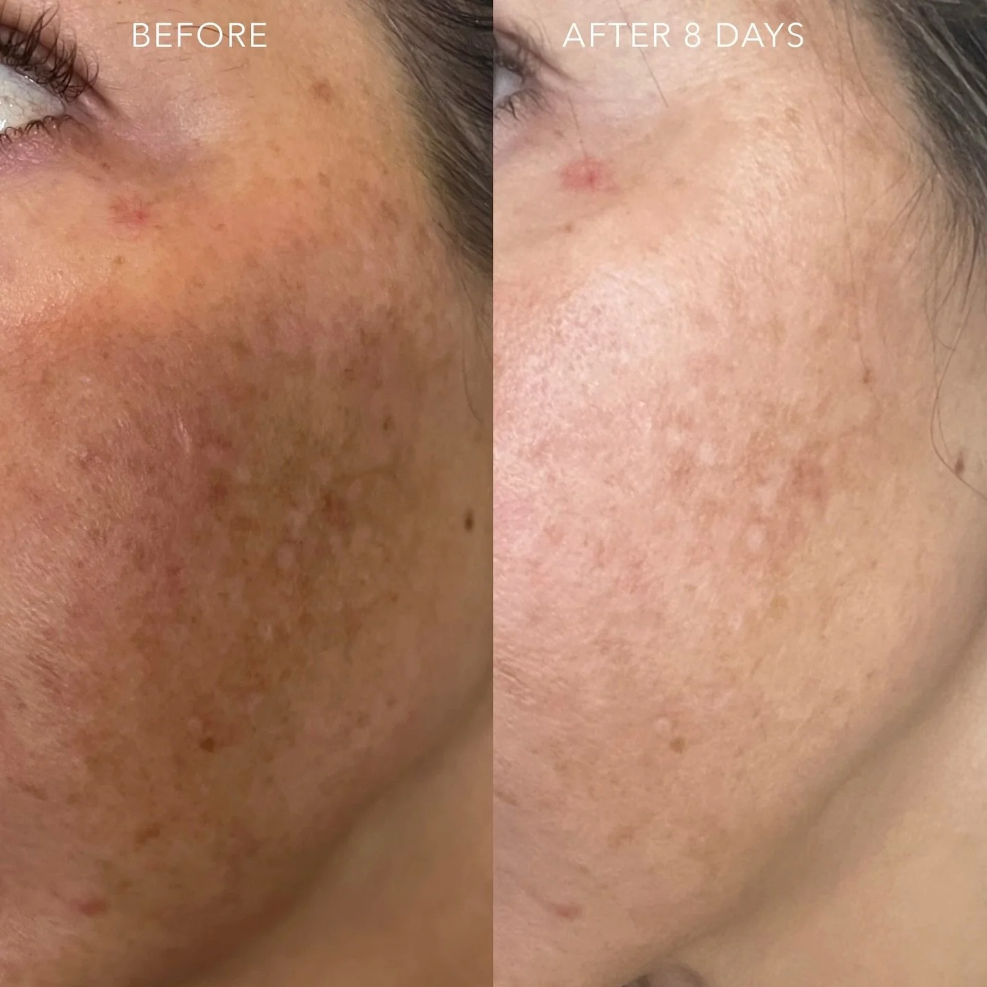 Visible improvement in only 8 DAYS! 

✨Ready for brighter, more even skin? Discover the power of Hydrinity medical-grade skincare at our medspa. Unlike over-the-counter products, these serums are formulated with potent, high-quality ingredients that 