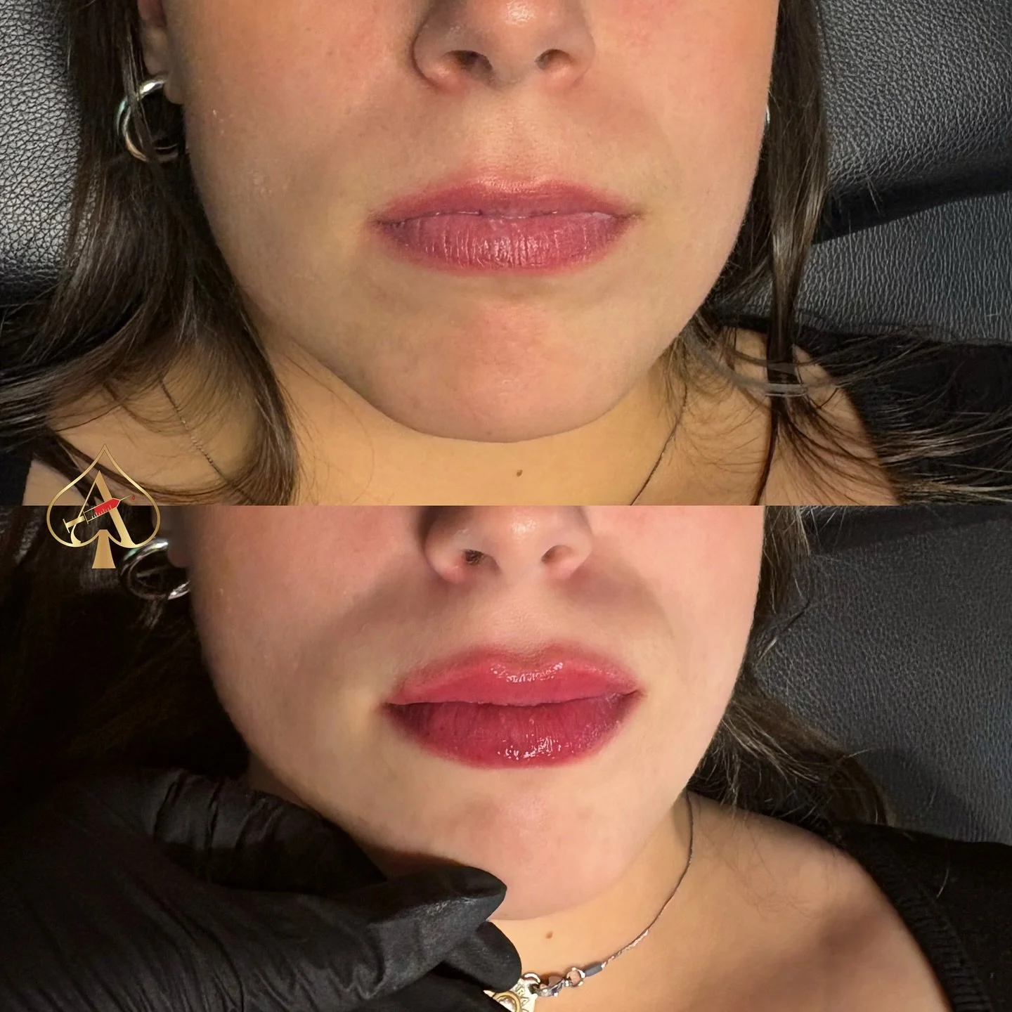 First-time lips, done the right way.

A mini plump that keeps your natural shape intact while adding smoothness, hydration and a little pop.

No overfilling.
No guessing.
Just elevated results.

DM to book your pre-holiday appointment 💋

- - - - - -
