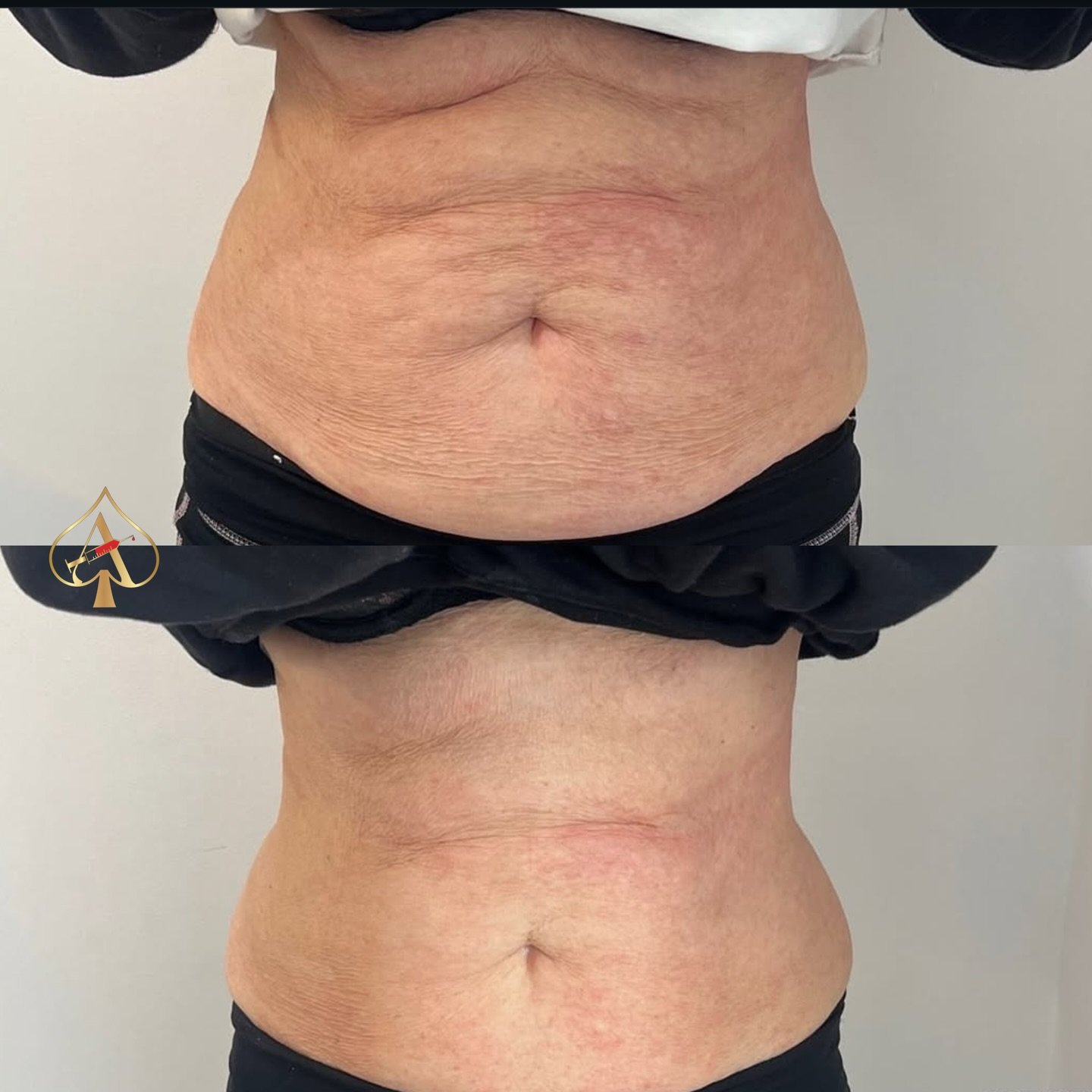 RF &amp; Red Light Therapy = No pain, no downtime, no crop top excuses! 

 Why RF?
	&bull;	Lifts and tightens loose skin
	&bull;	Stimulates natural collagen and elastin
	&bull;	Smooths fine lines and wrinkles
	&bull;	Firms jawline and contours the fa