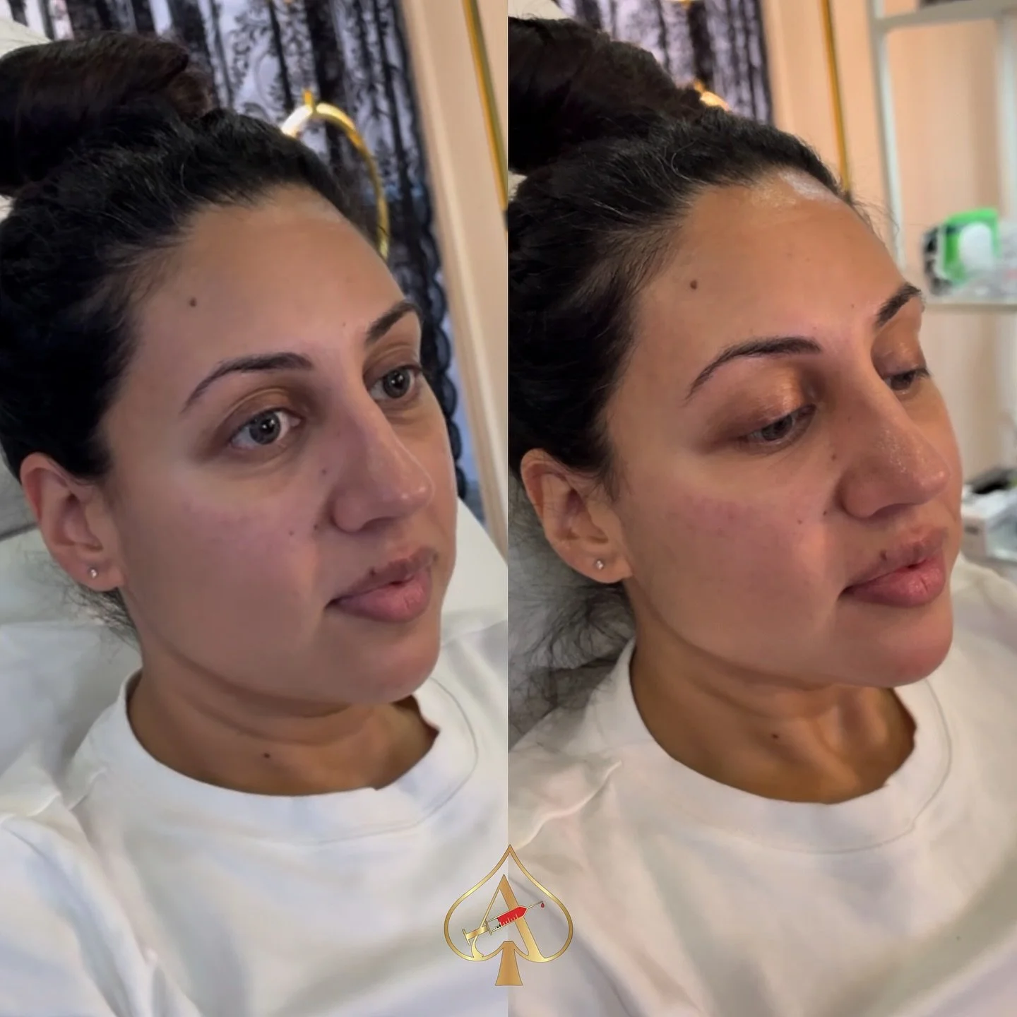 Swipe to see this beauty&rsquo;s defined jawline 📐.

True facial balancing isn&rsquo;t about chasing volume &mdash; it&rsquo;s about creating clarity in your features. When the right points are supported, the whole face lifts, tightens, and naturall
