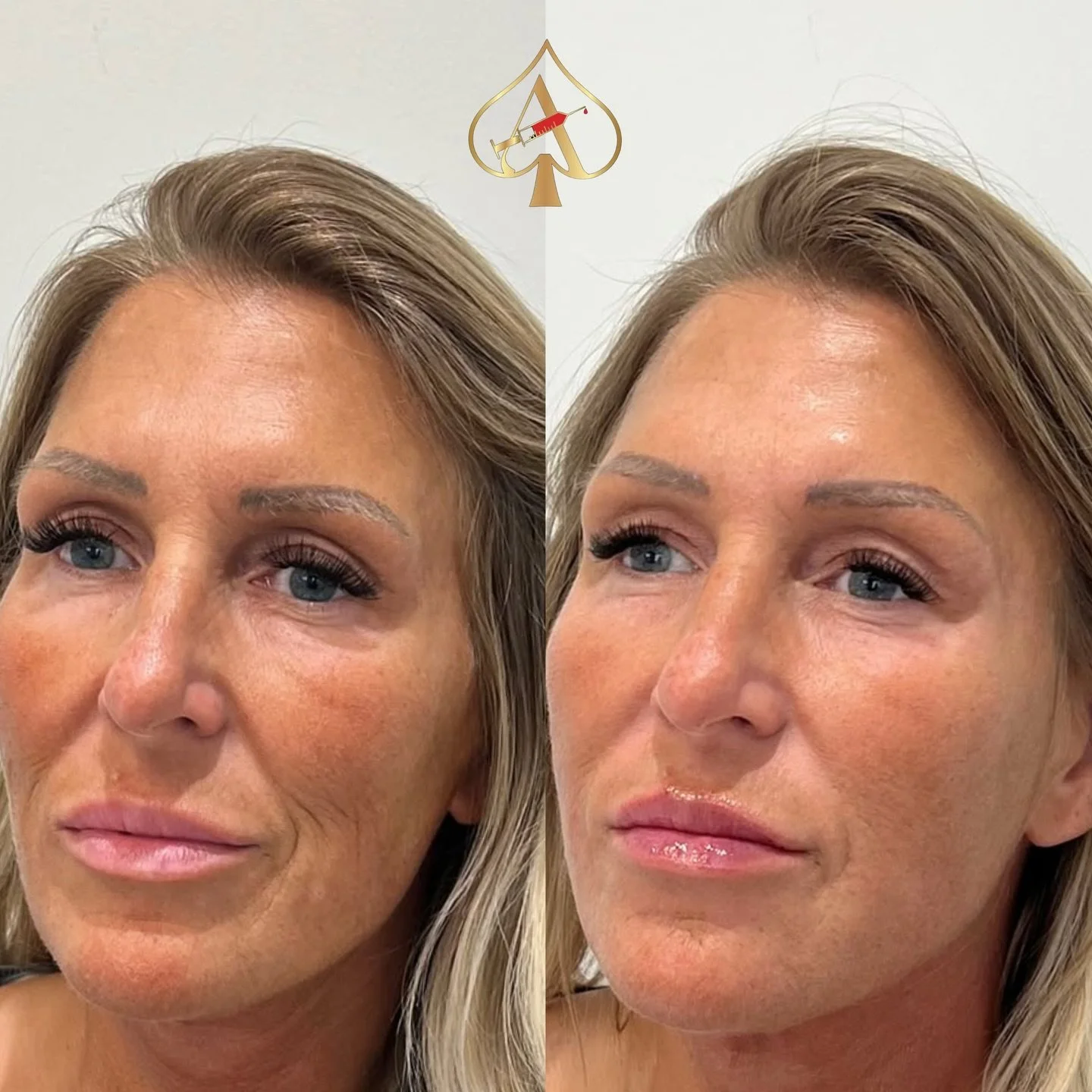 The anti-aging treatment that keeps everyone guessing&hellip; and your age a secret. 👀✨

Biostimulators (Sculptra/RPL) are the reason clients walk out with skin that looks lifted, firm, and impossibly smooth &mdash; and no one can ever pinpoint why.
