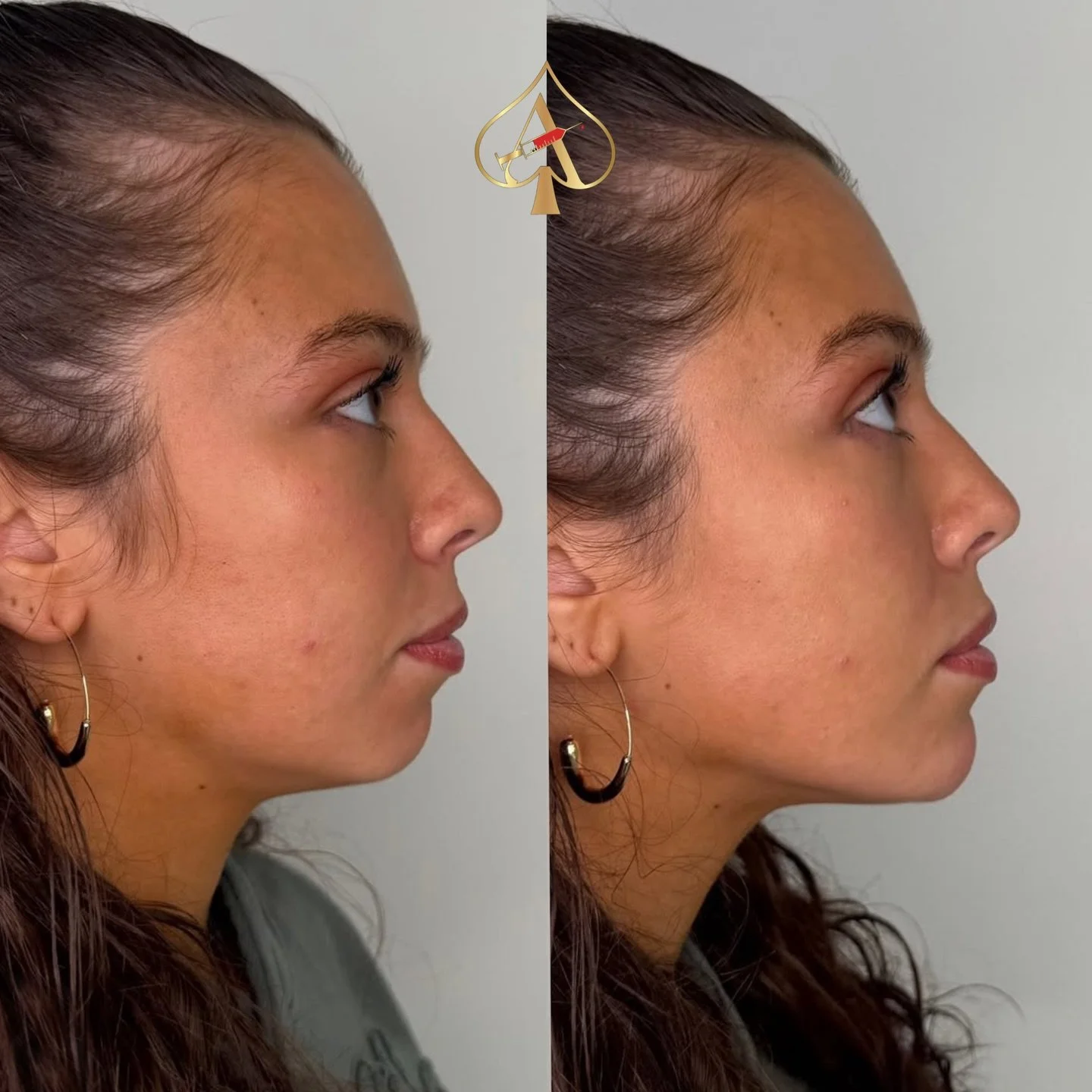 Chin Filler Transformation ✨

Consider this your reminder that balance changes everything. A little structure. A little projection. A whole lot of confidence.

Chin filler is one of the most underrated treatments for facial harmony &mdash; it sharpen