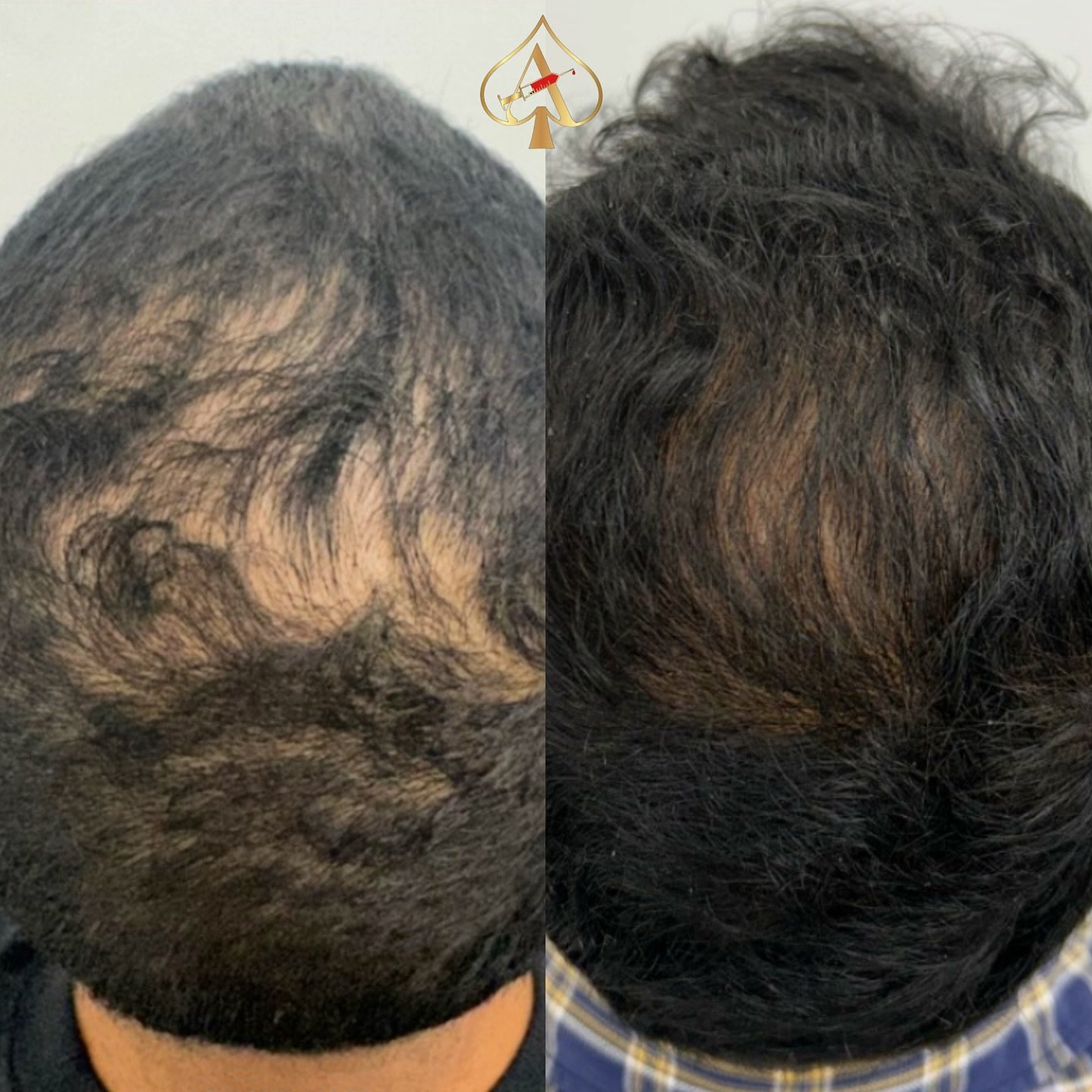 Thinning hair doesn&rsquo;t mean the end &mdash; it means your scalp needs support 🤍

PRF Hair Restoration uses your own growth factors to wake up dormant follicles, improve density, and slow shedding over time.

No chemicals. No fillers. Just regen