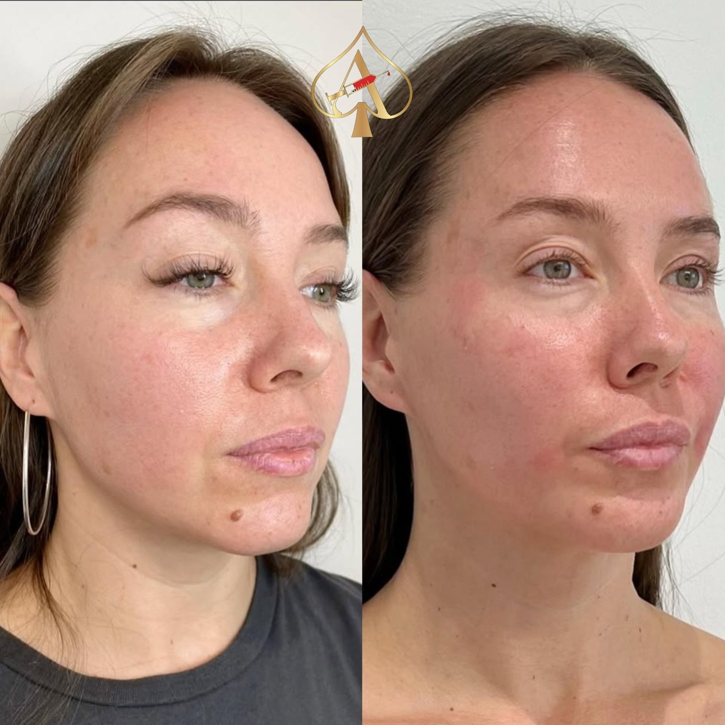 If you want to age gracefully&hellip; start where collagen ends.

Biostimulators (Sculptra/RPL) are the secret behind those quietly youthful faces &mdash; the ones that look lifted, smooth, and refreshed without a single obvious tweak.

This isn&rsqu