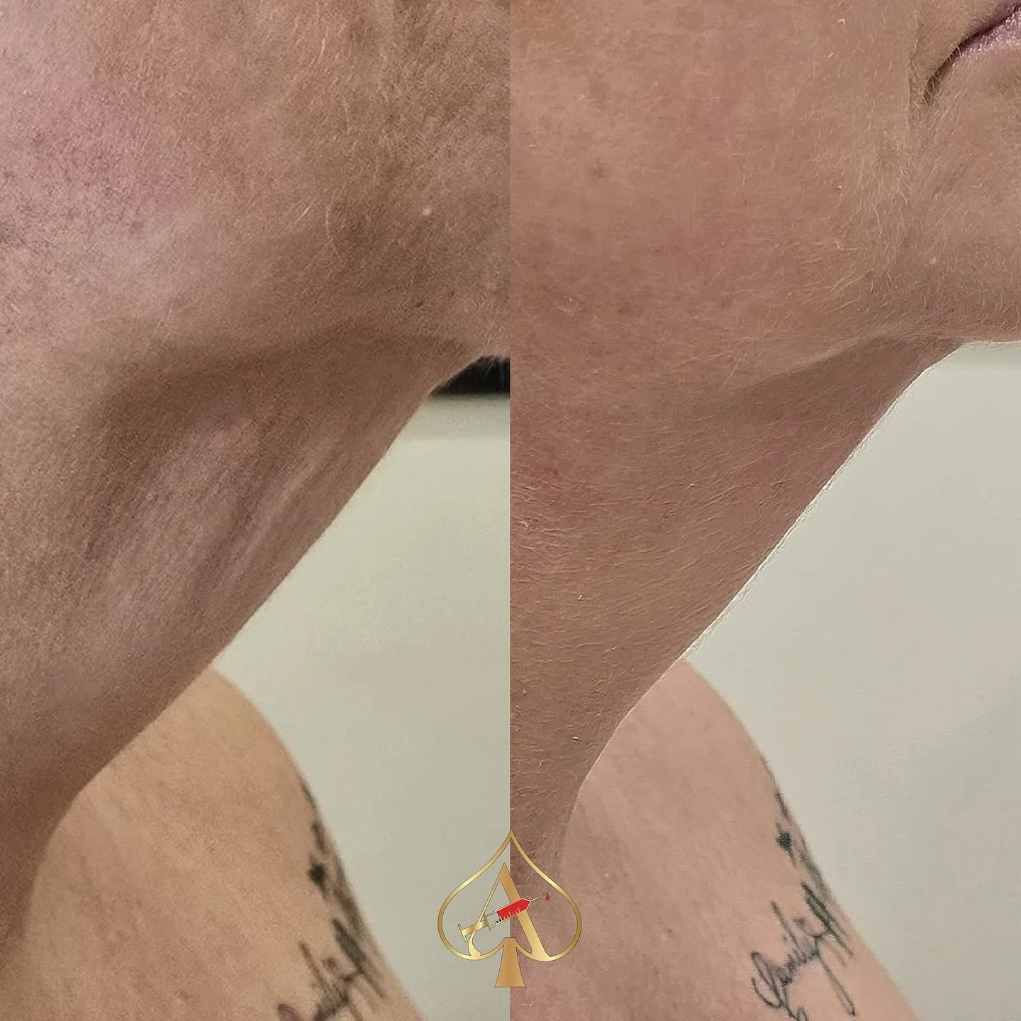 No needles, no downtime, just a smoother, firmer neck. Curious? ✨

RF skin tightening + red light therapy is a non-invasive way to lift, firm, and rejuvenate your neck naturally. Say goodbye to sagging skin, fine lines, and &ldquo;tech neck&rdquo; wo