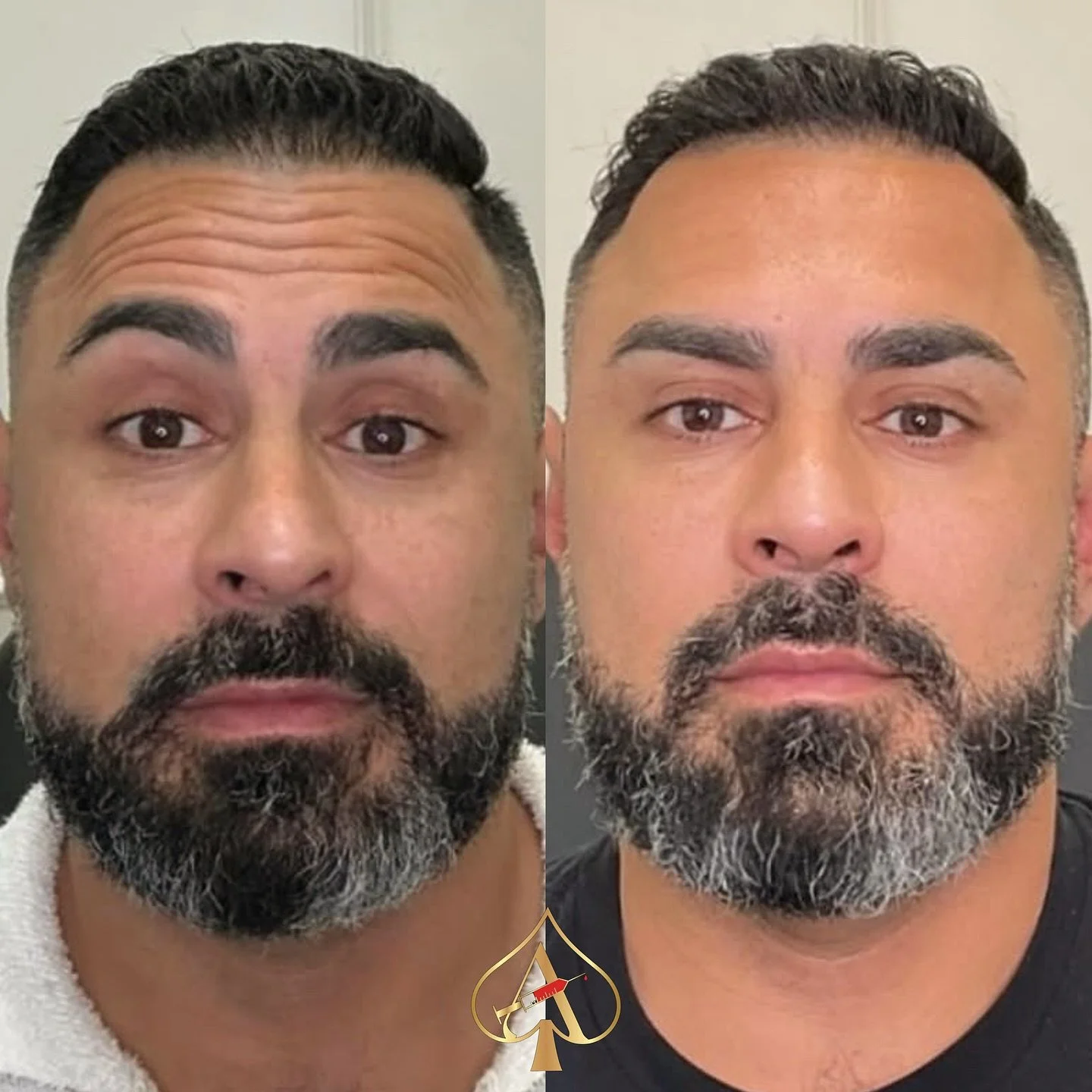 Brotox: Same face, sharper energy.

We softened the expression lines without touching what makes it masculine. No frozen look. Just well-rested, focused, and confident.

Because refinement should be subtle, not obvious.

- - - - - - - - - 

📍 Marca 