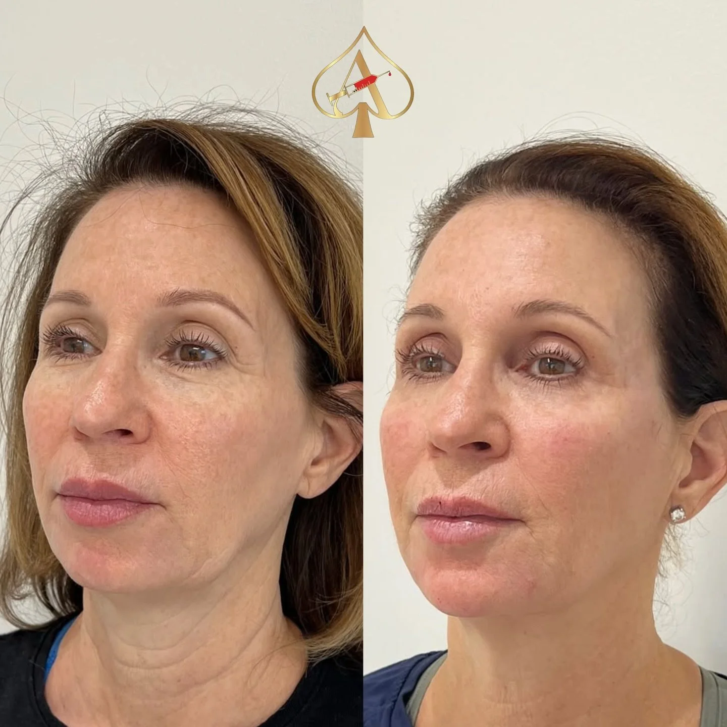 Our number one anti-aging treatment? Biostimulators. Because they (Sculptra/RPL) don&rsquo;t just fill &mdash; they rebuild.

Think collagen revival. Think skin that looks firm, lifted, smooth, and naturally youthful&hellip; without the &ldquo;I got 