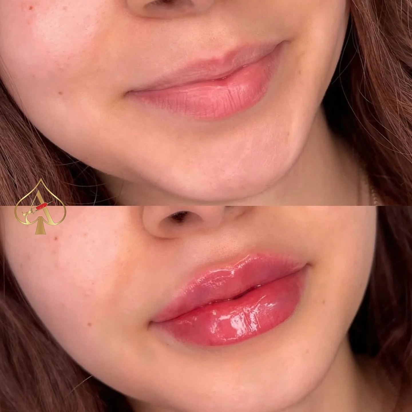 Thinking about lip filler but worried it&rsquo;ll be too much? Not sure how much you may need? Looking to discuss your lip goals for a gradual build? 

We&rsquo;ve got you covered! Take advantage of our complimentary consultations where we focus sole