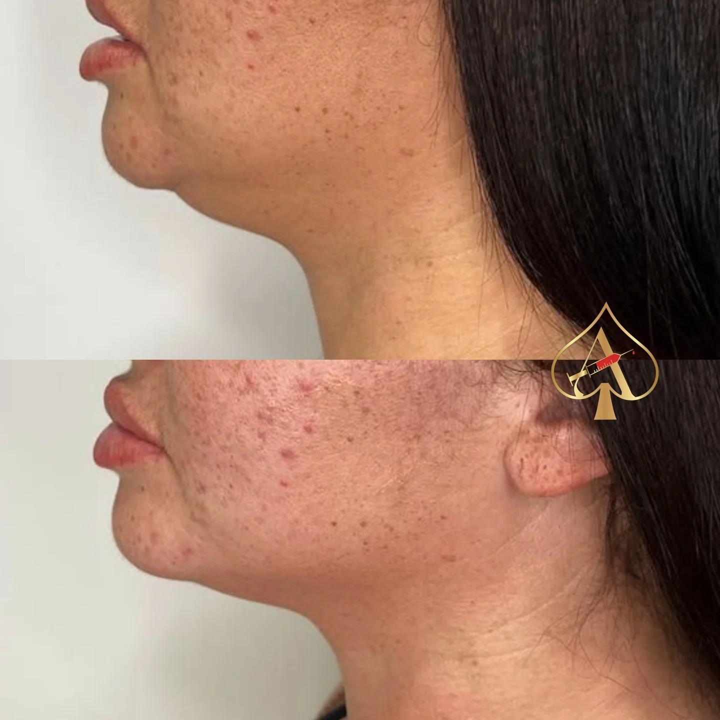Eliminate that double chin PERMANENTLY 💉 

PCDC (Phosphatidylcholine and Deoxycholate) fat dissolving injections are a non-surgical cosmetic procedure that is used to reduce localized pockets of fat in the body, particularly in areas that are resist