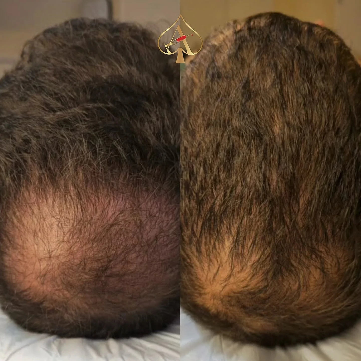 Hair growth isn&rsquo;t magic. It&rsquo;s science, medicine, and consistency.

If you&rsquo;re serious about thinning, shedding, or early hair loss, it takes more than oils and vitamins.

At the Spades Studio, we offer two regenerative treatments:

✨