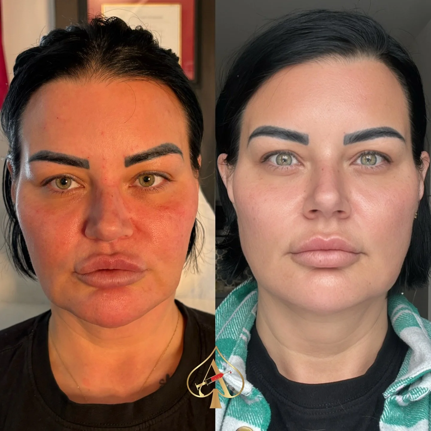 Next-day results with RPL Biolifting! 🚨
(Minimal swelling noted)

Meet the Ferrari of anti-aging treatments: Rich PL &ndash; a game-changer in skin rejuvenation! This pioneering solution combines the power of Hyaluronic Acid and Polylactic Acid in a