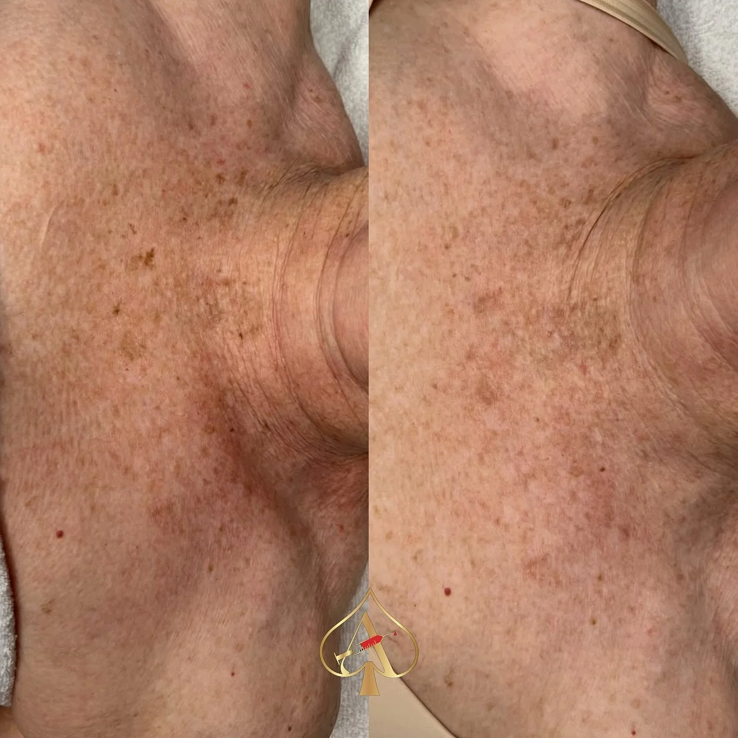 Your chest can show your age before your face &mdash; and it&rsquo;s one of the most rewarding areas to treat ✨

These results are from RF skin tightening + red light therapy on the d&eacute;colletage, and the transformation speaks for itself:
&bull;