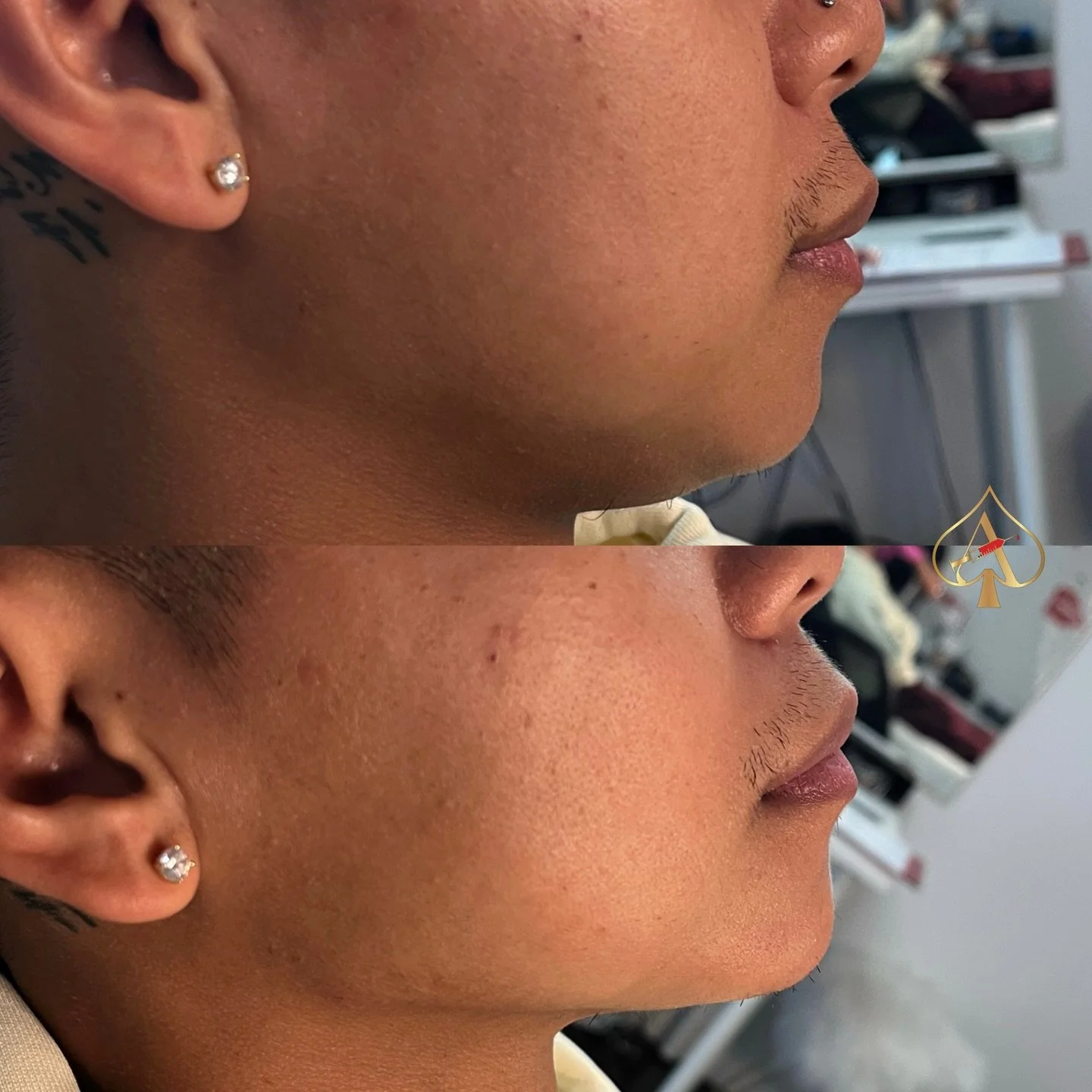Sharpening jawlines one syringe at a time 😻

Say goodbye to a weak side profile and hello to enhanced definition. Boost your confidence with a quick, non-surgical solution that provides natural-looking results. Ready to elevate your profile? Let&rsq