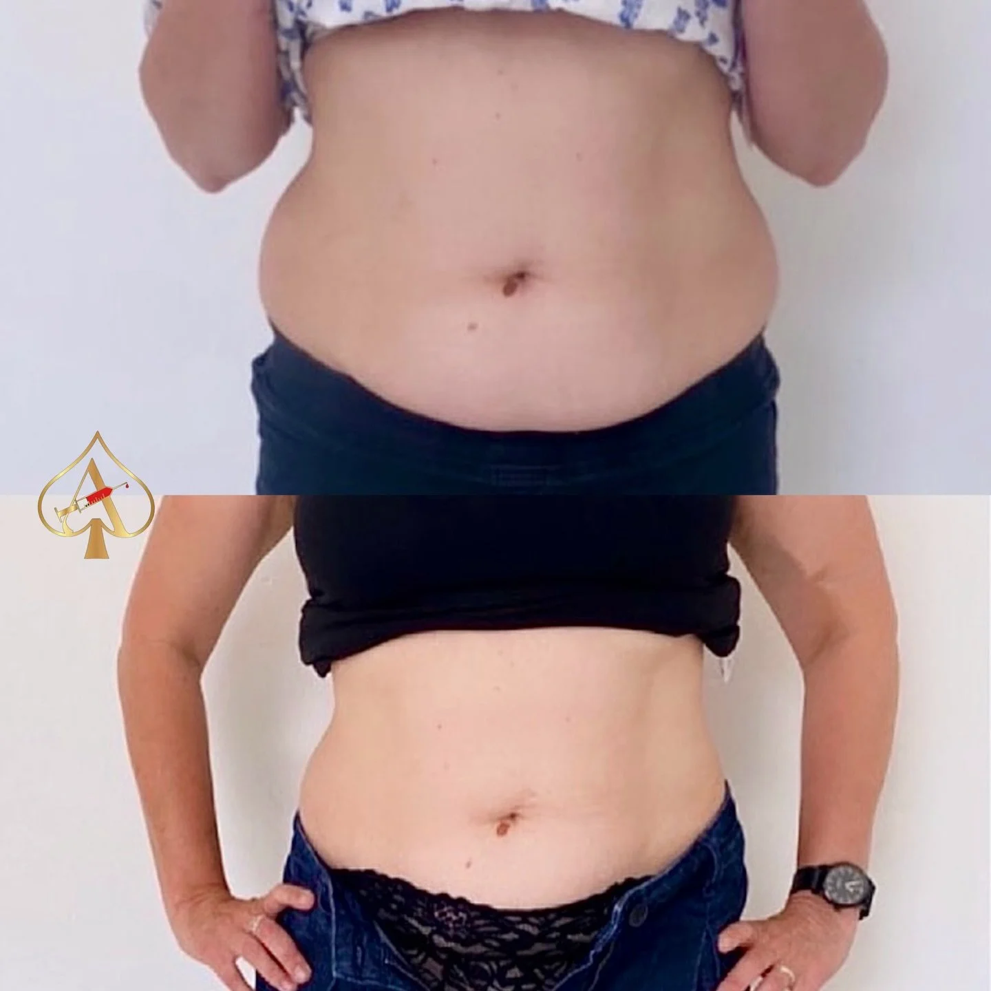 New year, stronger habits, smarter results ✨

Your workouts and clean eating do the work &mdash; PCDC helps target stubborn fat pockets that don&rsquo;t want to budge. It works by breaking down fat cells so your body can naturally flush them out over