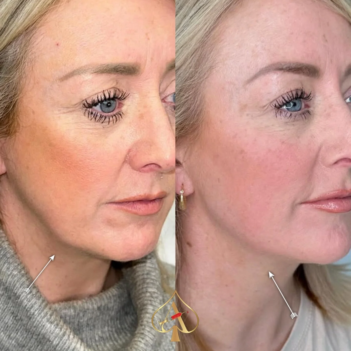 Nefertiti Neck Lift 💉 

✨ Why we love this treatment ✨

✅ Accentuates jawline 

✅ Reduce fine lines and wrinkles 

✅ Reduces jowls 

✅ Tightens sagging skin 

✅ Lifts neckline 

✅ Rebalances muscles
&amp; more! 

Book a complimentary consultation to