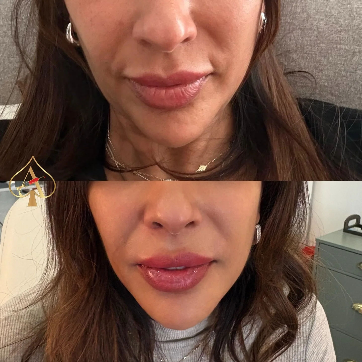 Lower face = everything.

A balanced chin.
A softened fold.
A subtly fuller lip.
And suddenly the whole face looks lifted, sculpted, expensive.

This is what strategic facial balancing does &mdash; not &ldquo;more filler&rdquo;&hellip; just harmony.
