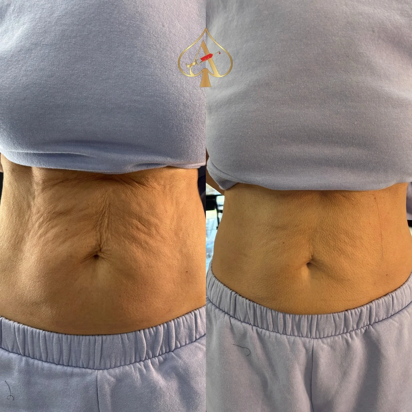 This is our RF + Red Light Therapy &mdash; the same high-performance device trusted in top Dubai clinics, now at the Spades Studio. ✨

Think: next-gen skin tightening powered by intelligent radiofrequency + therapeutic red light energy.

What it trea