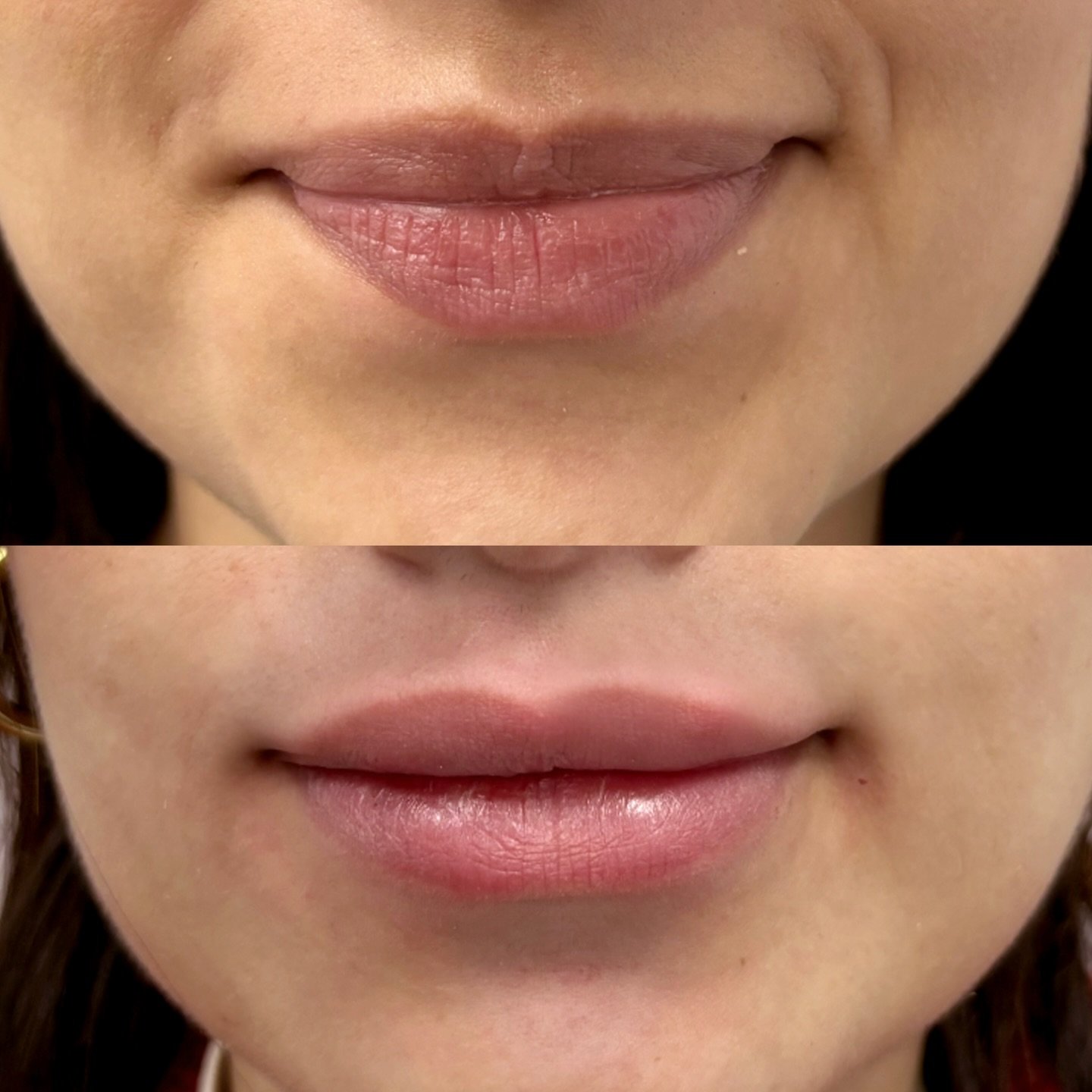 Scared of lip filler but hate dry, wrinkled lips? Read this. 👇🏼

This is NOT filler.
This is Skinfill Bacio &mdash; a next-gen lip skin booster designed to:

💧 Deeply hydrate from within
💋 Smooth fine lip lines
✨ Improve lip texture + softness
🌸