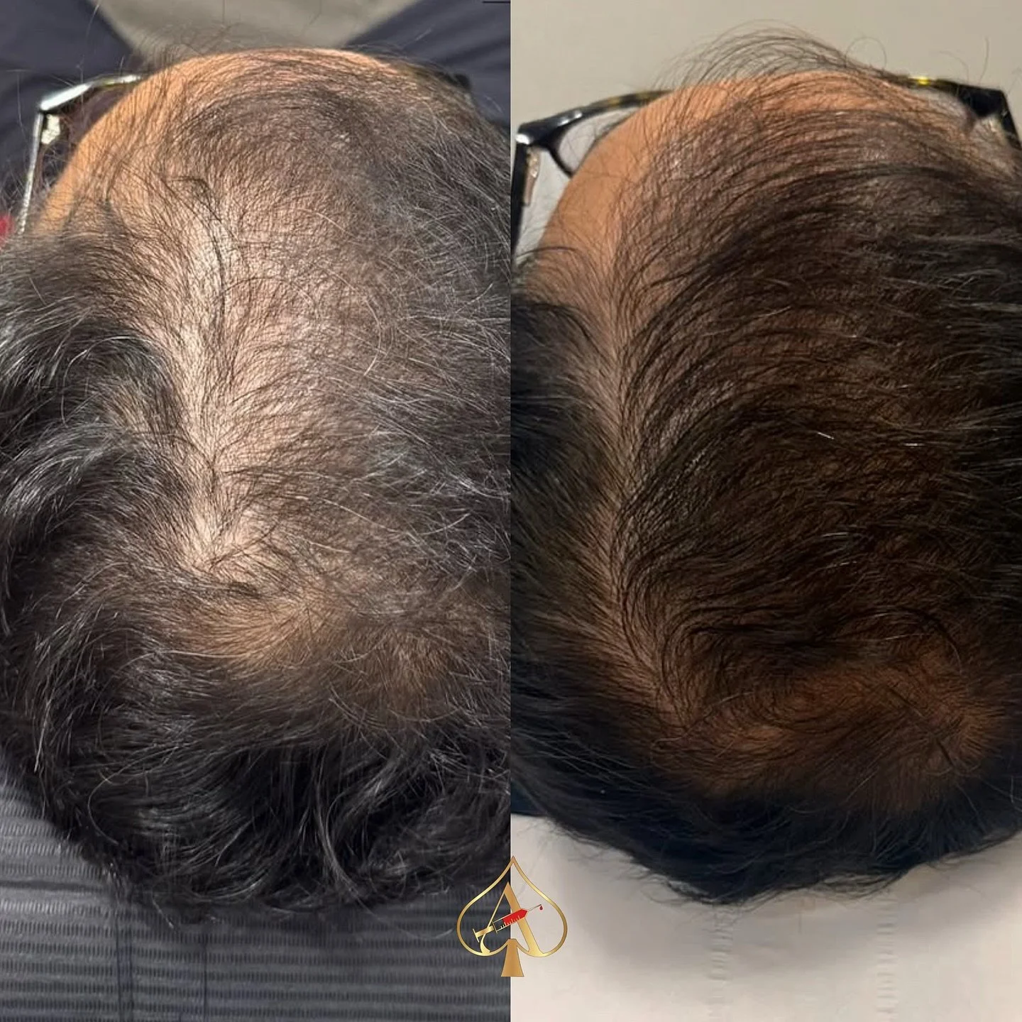 If PRP didn&rsquo;t give you the regrowth you were hoping for&hellip; read this. 👇🏼

Hair thinning, postpartum shedding, stress loss, hormonal changes &mdash; sometimes your scalp needs more than just stimulation. It needs regeneration.

✨ Exosomes