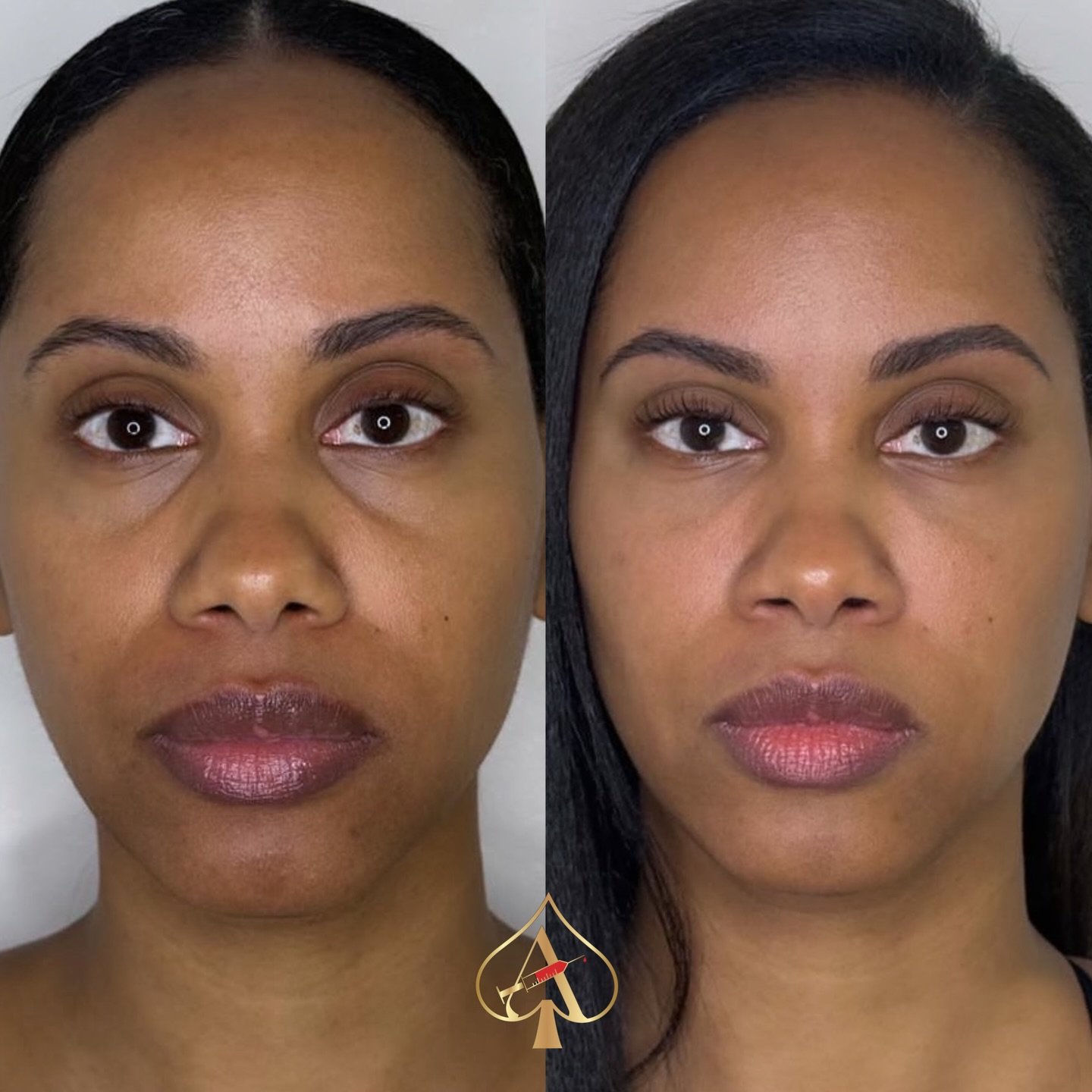 POV: You want volume and rejuvenation&hellip; but not filler.

PRF Biofiller uses your body&rsquo;s own growth factors to create a natural &ldquo;filler&rdquo; that restores volume, improves skin quality, and stimulates collagen.

We simply draw a sm