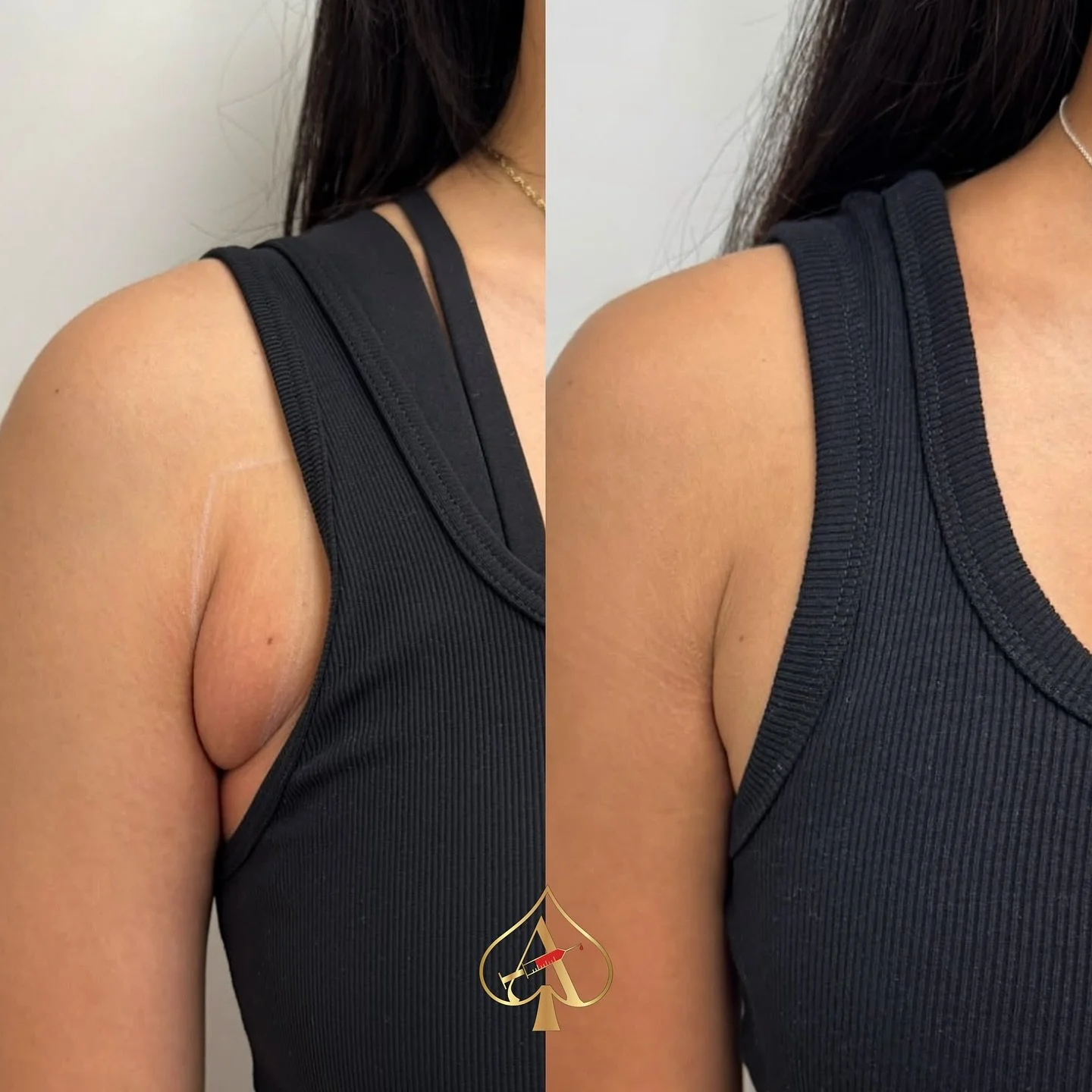 Let&rsquo;s talk about the bra bulge nobody likes to admit bothers them.

You can work out.
You can eat well.
You can lose weight.

And that small pocket by the armpit can still stay exactly where it is.

That&rsquo;s because it&rsquo;s often localiz