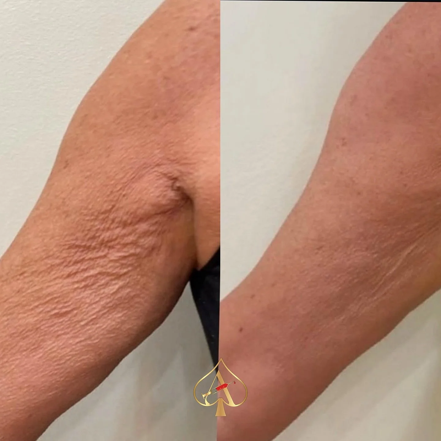 Loose or crepey skin doesn&rsquo;t have to be permanent.

Our RF and red light therapy treatment helps stimulate collagen, improve elasticity, and tighten the skin over time &mdash; creating a smoother, firmer appearance.

This technology gently heat