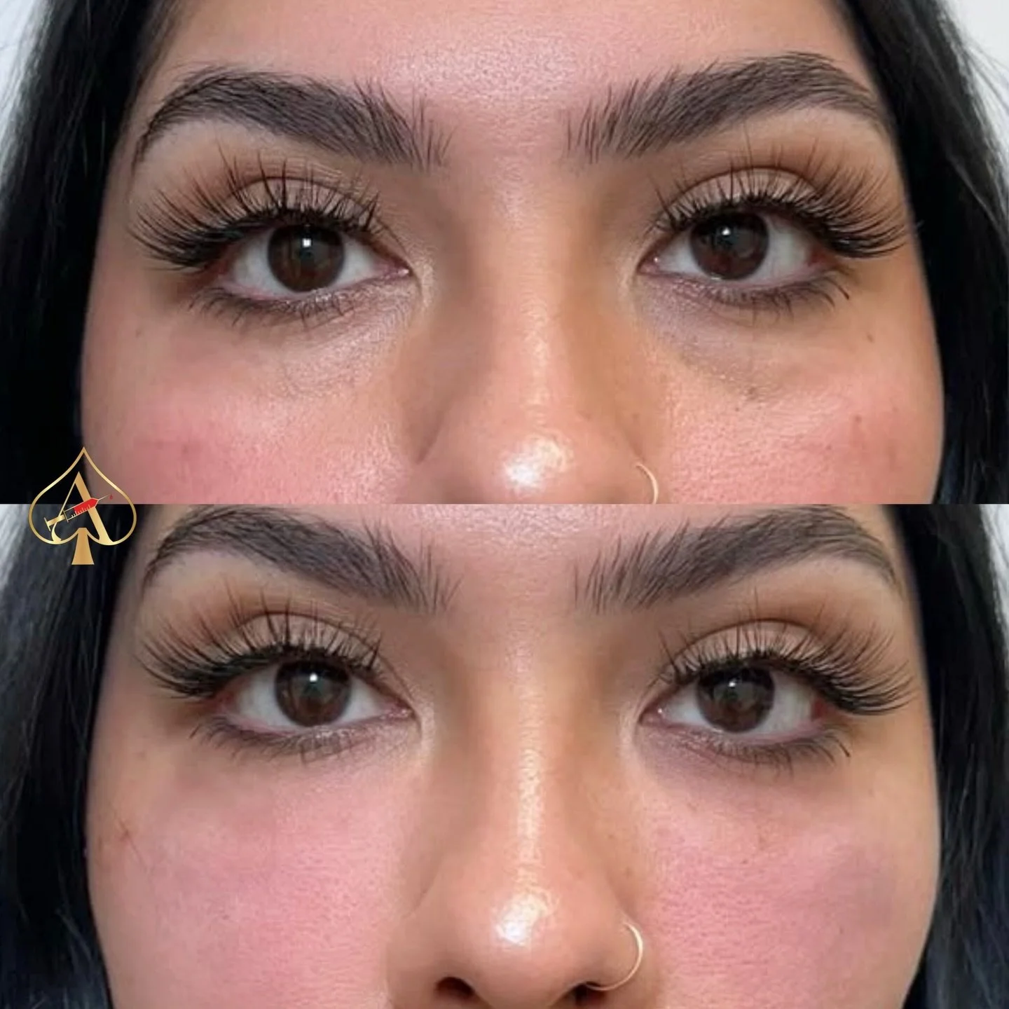 If hollowness, darkness, or crepey texture are making you look constantly tired&hellip; this is your sign to skip the filler and go regenerative. 😏 

Our undereye skin booster treatment works beneath the surface to deeply hydrate, smooth, and restor