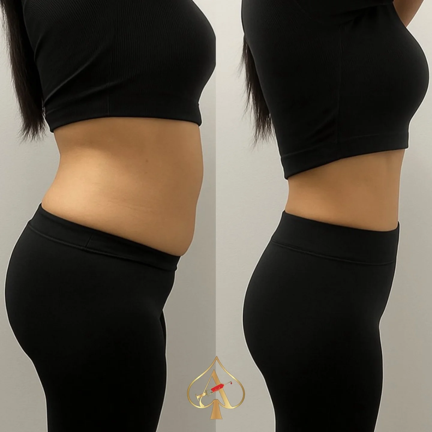 Body transformations aren&rsquo;t created overnight.

They come from discipline, movement, better choices, and consistency.

We&rsquo;re incredibly proud of this client who has been committed to her diet and exercise routine, and allowed us to suppor