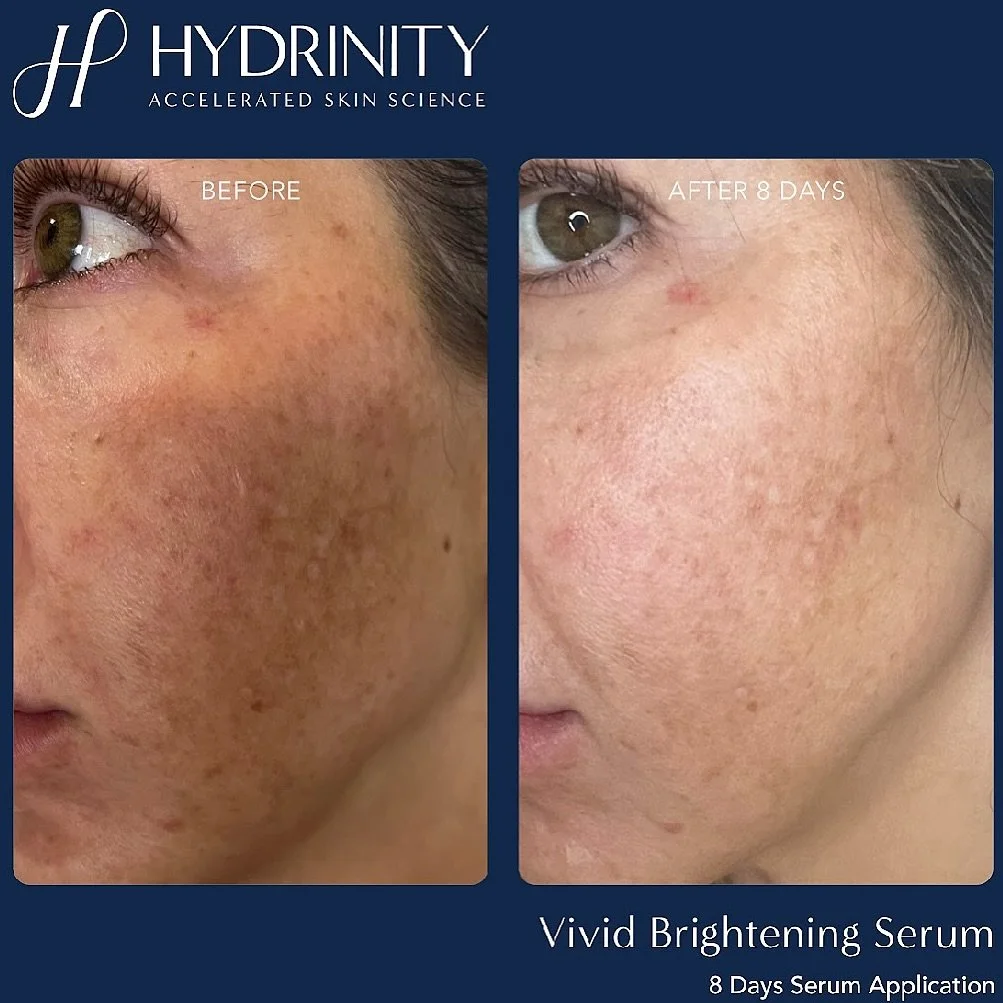 Targeting pigmentation&hellip; without the needles 💉. 

The Hydrinity Vivid Brightening Serum is your non-invasive glow solution&mdash;designed to visibly brighten, even tone, and soften discoloration while keeping your skin hydrated and healthy.

F