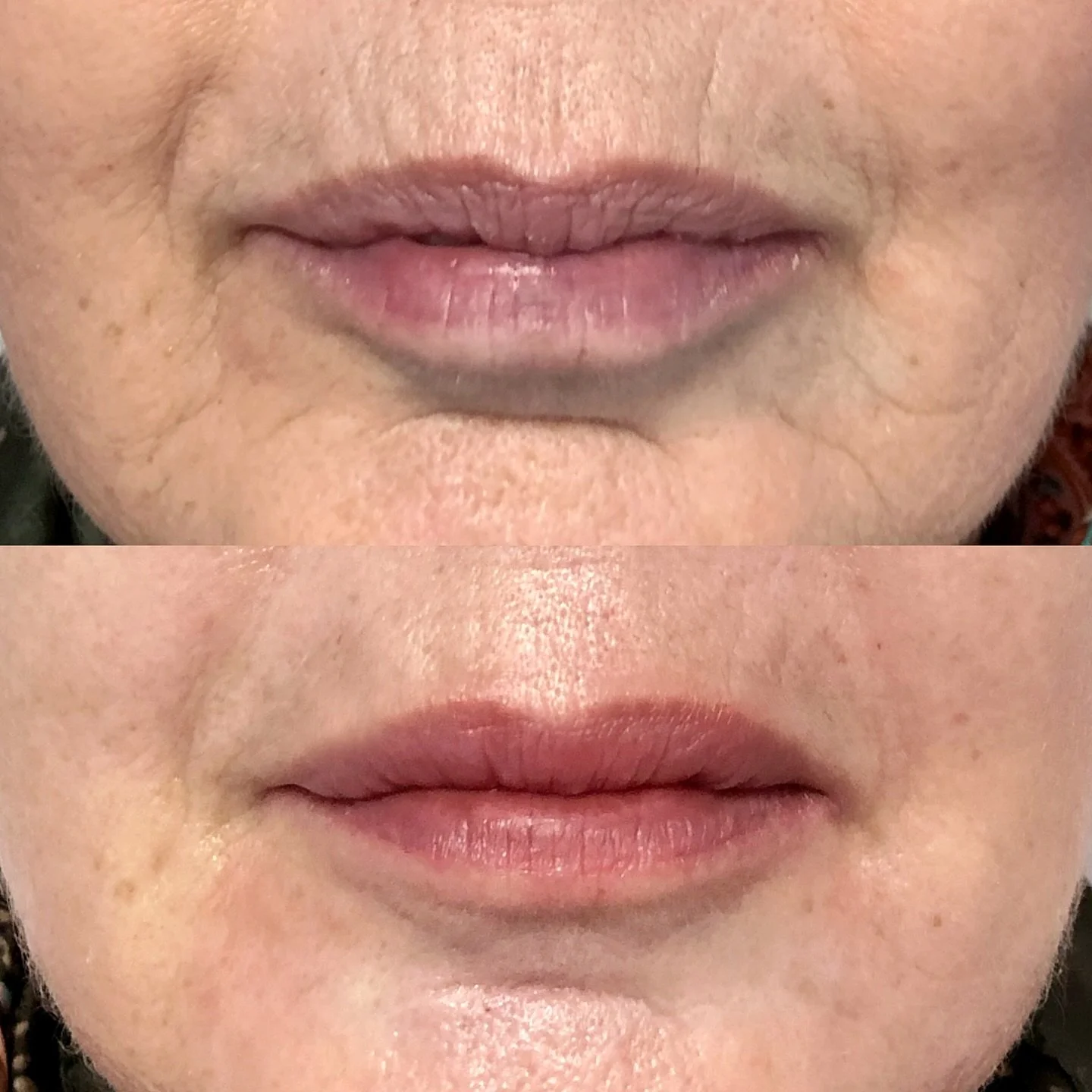 Your lips don&rsquo;t need more volume. They need hydration. 💧

If you&rsquo;ve been saying: &ldquo;I don&rsquo;t want bigger lips&hellip; I just want them smoother.&rdquo;

Skinfill Bacio is your girl. Look how it rejuvenates not only the lips, but