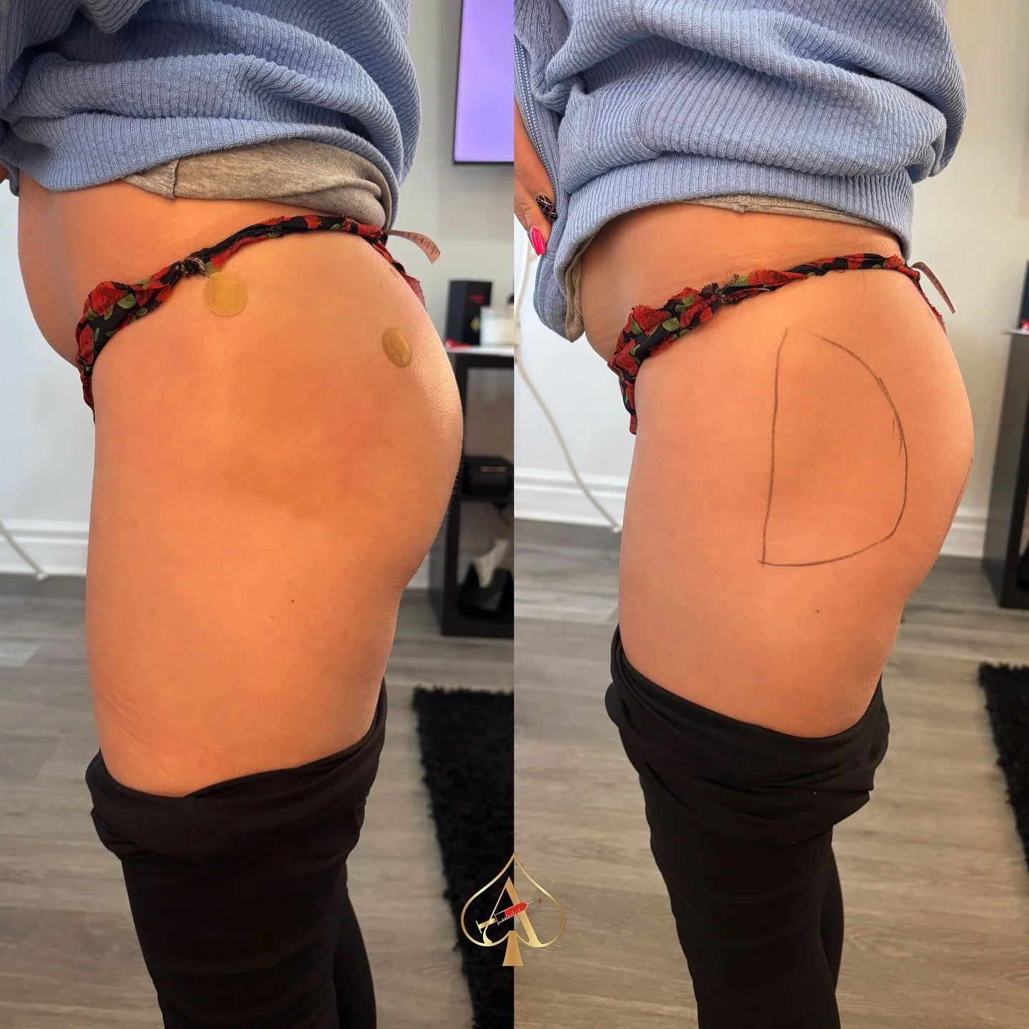 Lifted, sculpted, natural-looking booty without surgery? ✨

The DreamCurve&trade; BBL technique is designed to enhance your curves in all the right places &mdash; giving you that smooth, rounded, and balanced look you&rsquo;ve been dreaming of. No do