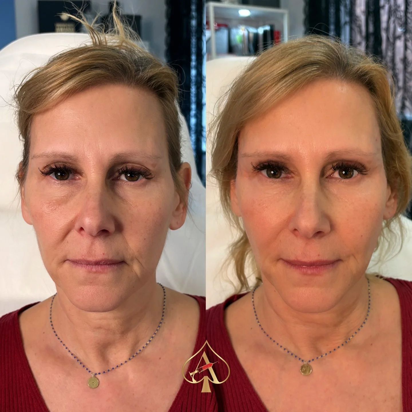 Meet the Ferrari of anti-aging treatments: Rich PL &ndash; a game-changer in skin rejuvenation! This pioneering solution combines the power of Hyaluronic Acid and Polylactic Acid in a liquid form, designed to hydrate, restore volume, and tighten your