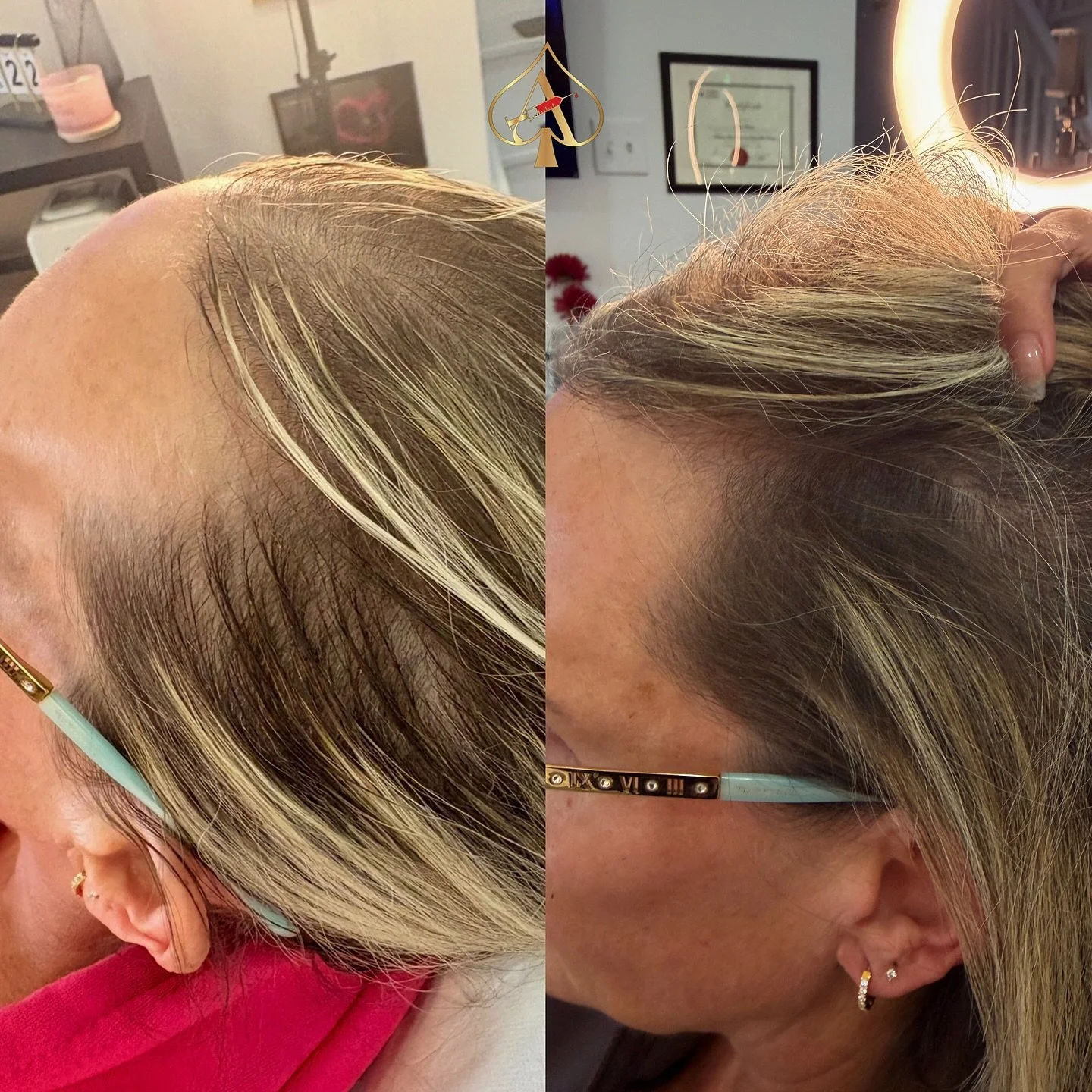 3 sessions. Real growth. Real confidence restored. 👏✨

This client&rsquo;s transformation with our exosome hair restoration protocol has been incredible to witness. From thinning and weakened follicles to visibly fuller, healthier hair growth &mdash