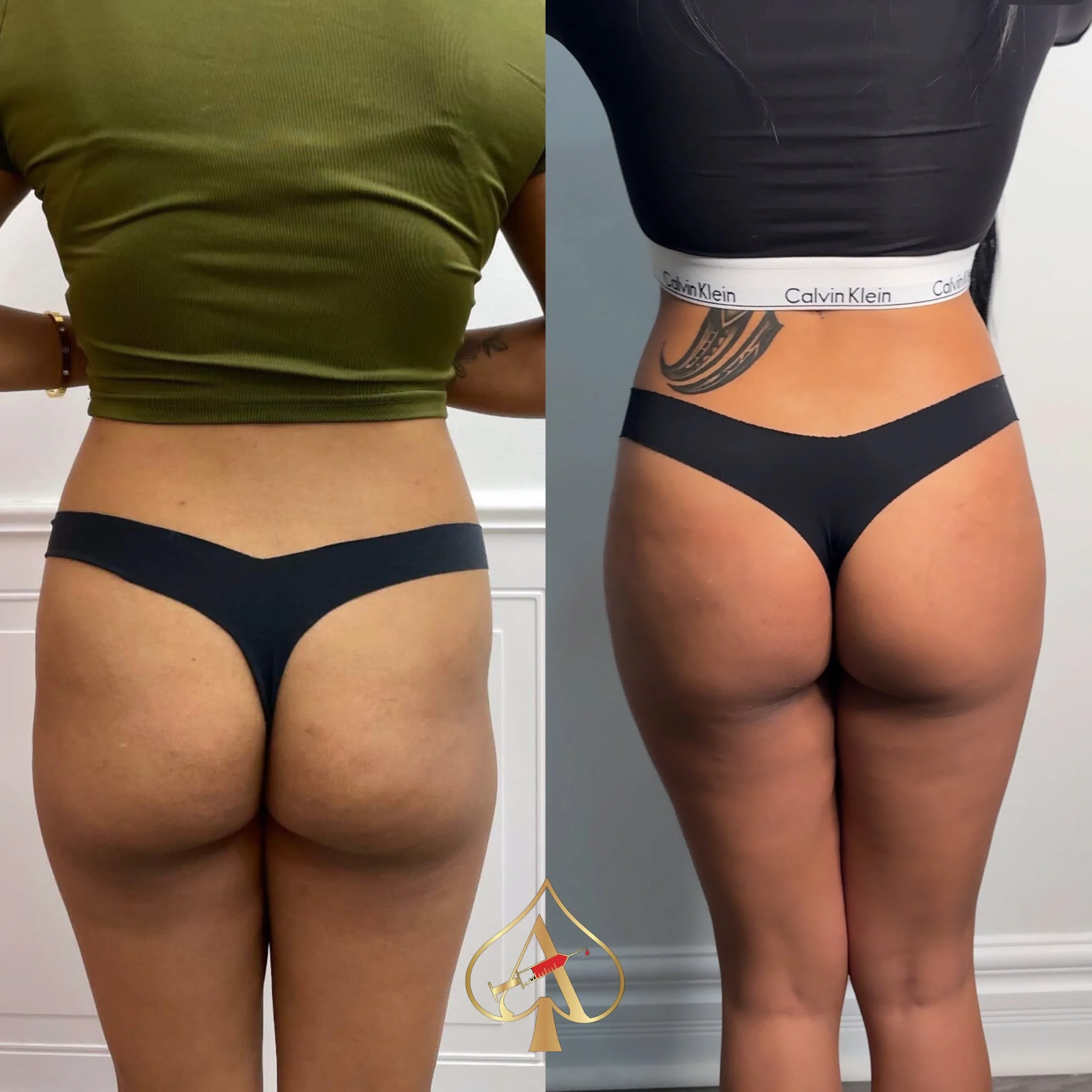 Hip dips? Gone. 🍑✨

This transformation was built over a series of customized sessions using a combination of filler + biostimulators for:

&bull; smoother hip contours
&bull; better projection
&bull; natural-looking volume
&bull; long-lasting colla
