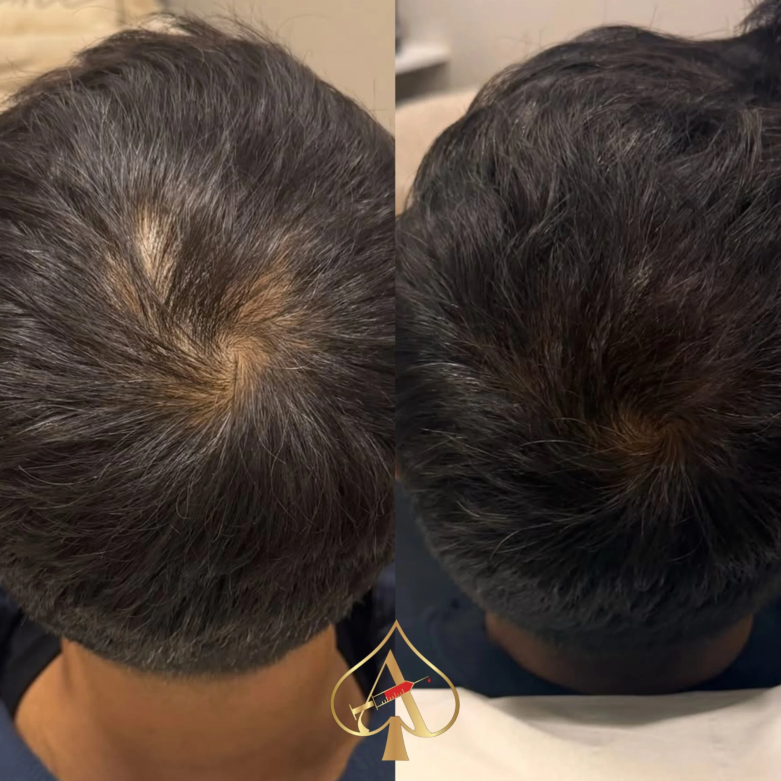 Tired of using Minoxidil forever just to maintain results?

This is what REAL hair regeneration looks like after only TWO sessions. 👀

Unlike products like Minoxidil or Rogaine that often require daily lifelong use to temporarily stimulate hair grow