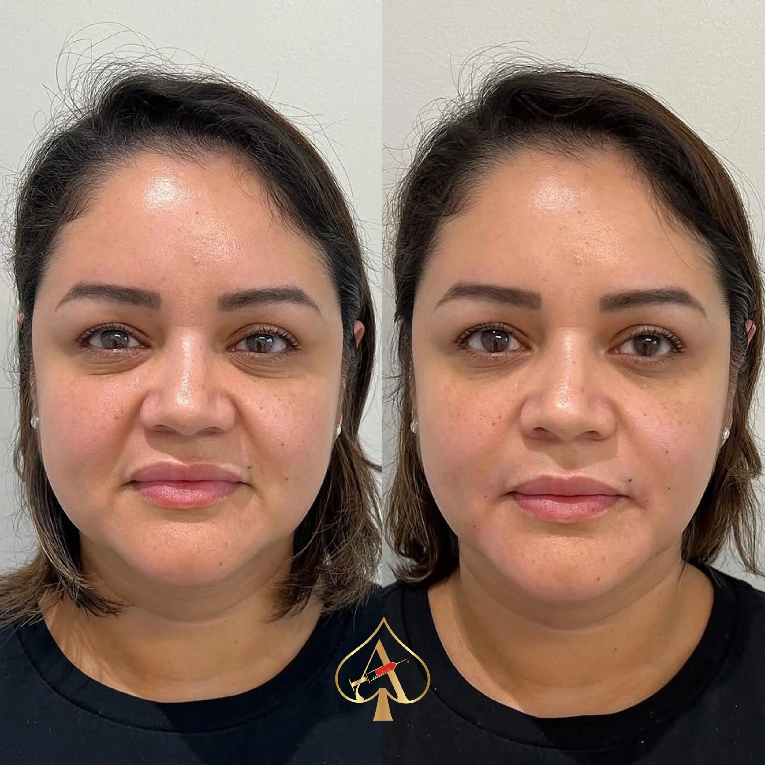 Not your average glow-up ✨

The Ace Lift technique is all about strategic balance, subtle structure, and enhancing what&rsquo;s already beautiful &mdash; lifted, refreshed, and naturally YOU &spades;️

No overdone look. No guessing. Just carefully pl
